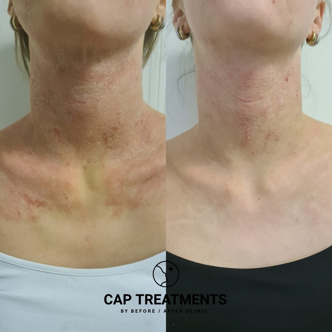 Vi är på väg! 💕
#tsw #topicalsteroidwithdrawal #capbehandling #eczema
