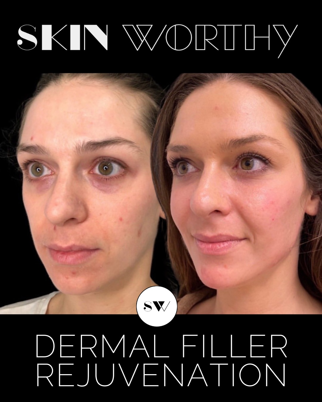 We get it. You’ve seen the overfilled lips, the puffy cheeks, the faces that just don’t look like themselves anymore. And it makes you hesitant.
But here’s the truth:
Dermal fillers and Botox are just tools.
The outcome comes down to the person holding the syringe:
their understanding of anatomy,
their eye for balance,
their restraint,
and their plan.
In this transformation, we didn’t add “more”, we restored what was lost and created what was desired to help our patient look like how she felt. Subtle volume. Thoughtful structure. Natural movement.
The goal is never to change your face.
It’s to bring it back into harmony.
Choose your injector the way you’d choose a surgeon, a stylist, or a trainer; because it’s their skillset that shapes your results.
✨ Natural. Balanced. Undetectable.