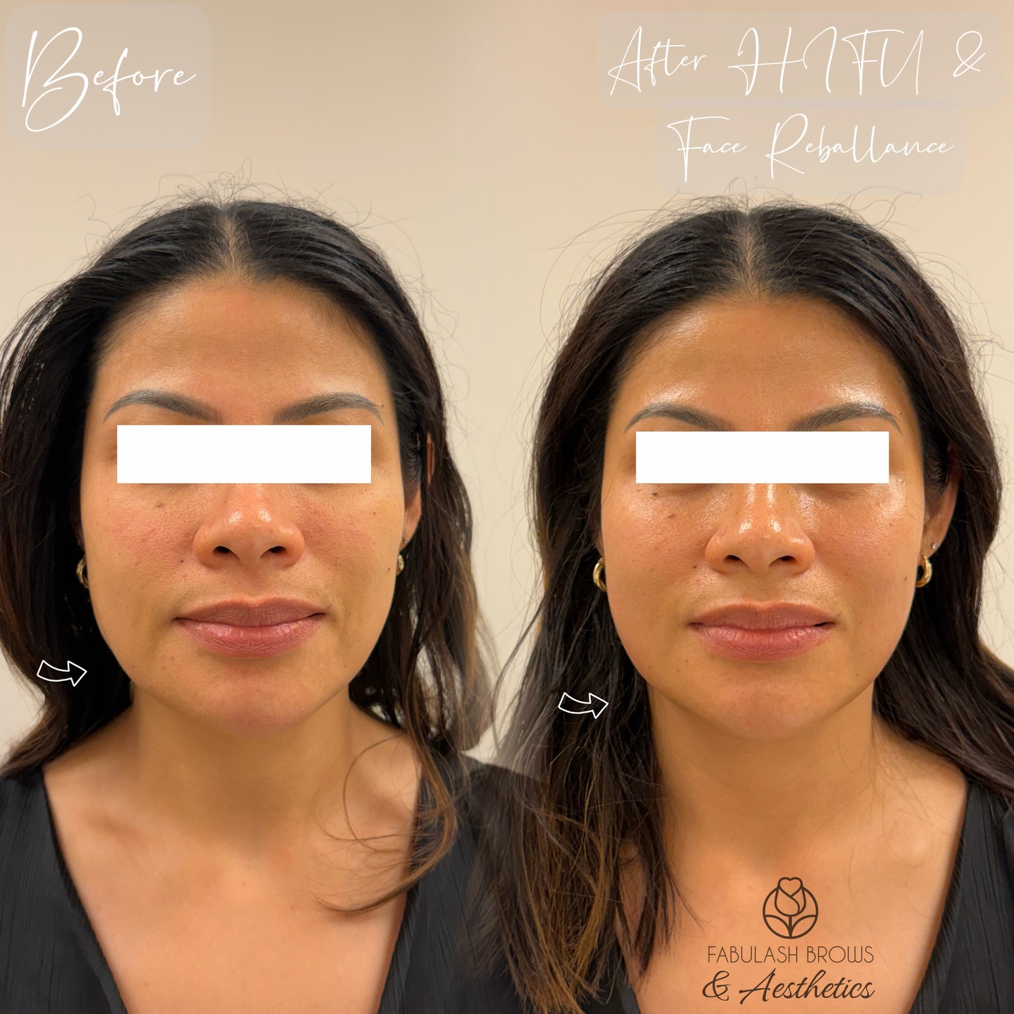 💁♀️Last HIFU face sculpture for my returning client before heading to Permanent Make Up Conference in Vietnam ❤️❤️🤩!
Sometimes you don’t have to do alot to look younger, just spend an hour with the right treatment at the right place 🤩🤩!
Don’t wait until your skin needs it! Let’s prevent or delay aging from to day !!! We now have 9 different machines with 6 newest technologies to treat all your skin need 💪💪!
☎️ Book Free Consultation with us 👇
Www.Fabulashbrows.co.nz
#hifufacelift #facesculpting #wellingtonskinclinic #skintighteningtreatment #judynguyennz