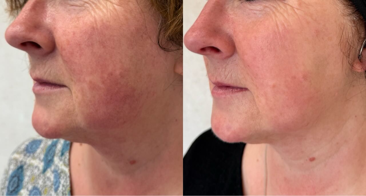 Efekt zostawania terapii przy użyciu światła szerokopasmowego w celu likwidacji rumienia i występujących przebarwień. ✨