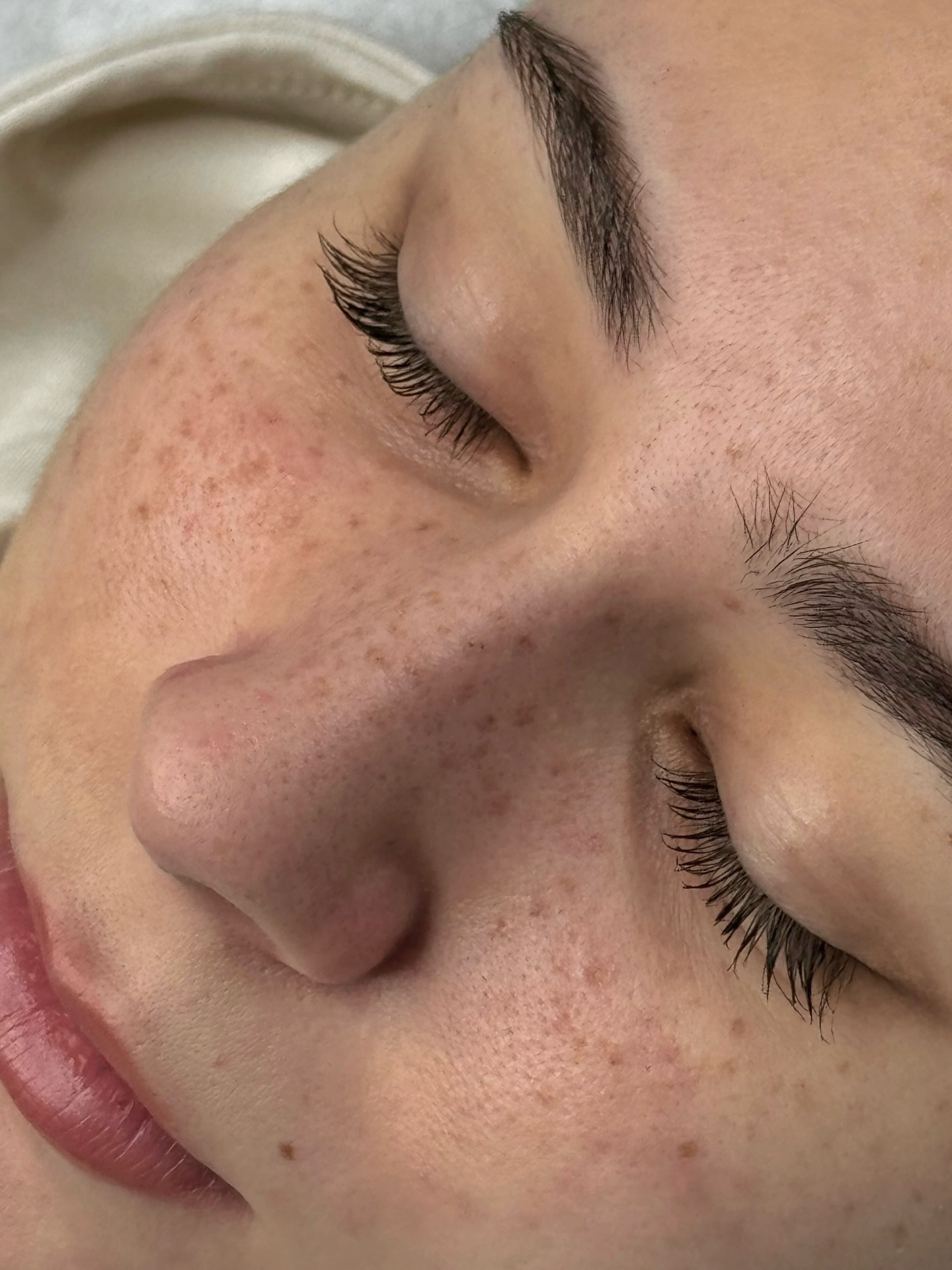 Taches de rousseur « beaucoup » cicatrisés ✨🩶
#tachesderousseur #chambery #freackles #tachesderousseurchambery #formationtachesderousseur