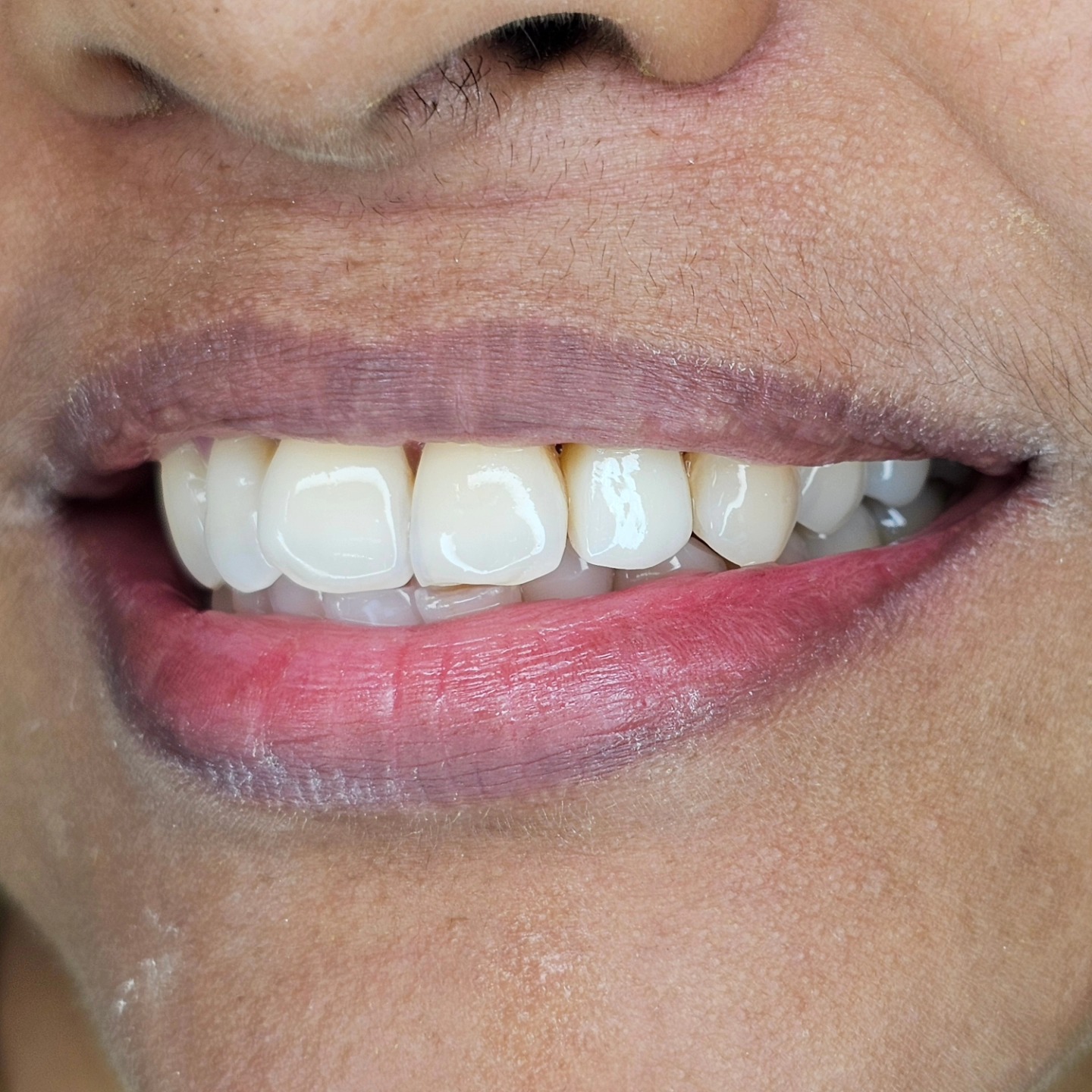 Swipe right to find out
Management of traumatic fracture of the tooth .
PRECISE PLEASANT AND AESTHETIC DENTISTRY
SETHU'S DENTAL HOUSE
#zirconia