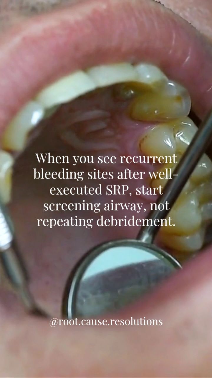 If a patient spends every night in intermittent hypoxia, fibroblasts cannot function normally, inflammatory mediators stay elevated, and attachment repair becomes limited regardless of how well the instrumentation was performed.
This is why airway assessment belongs in periodontal risk evaluation.
What to look for chairside:
➡️ Scalloped tongue
➡️ Narrow palate
➡️ Attrition / clenching
➡️ Mouth breathing
➡️ Daytime fatigue
Are your protocols up to date?
#airwaydentistry #wholebodyhealth #oralhealth #myofunctionaltherapy #RDH