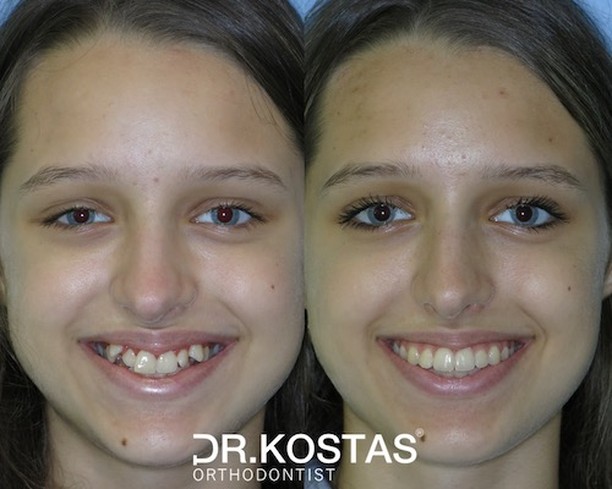 Face-driven orthodontics is our philosophy and key to success. Ema was unhappy with her smile and the appearance of her teeth. A non-extraction treatment approach was followed in her case with the Damon System and the results were more than rewarding. Hard work always pays off ๐๐
#drkostas #kostasortho #orthodontist #braces #dublinbraces #smile #smiletransformation #dublinorthodontist #smilemakeover #dublin #orthodontics #straightteeth #teethstraightening #damonbraces #smiletransformation #archwidening