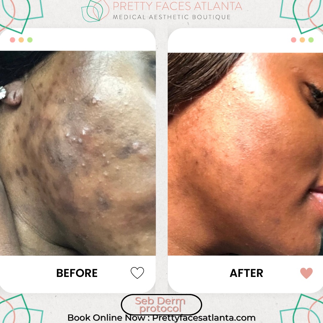Clear skin isn’t luck… it’s LASER 🔥
If you’re dealing with acne, dark spots, redness, or uneven texture, this is your sign to reset your skin the right way. Our advanced laser treatments target the root of the problem, not just the surface.
✨ Packages:
1 session – $500
2 sessions – $550
3 sessions – $800
The more you commit, the better your results. Real transformation happens in a series 👀
Smooth texture
Even skin tone
Faded acne + dark marks
Confidence back UP
Spots will go QUICK. Book your package now at PrettyFacesAtlanta.com 💻
#PrettyFacesAtlanta #AtlantaMedSpa #LaserSkin #ClearSkinJourney #PFA