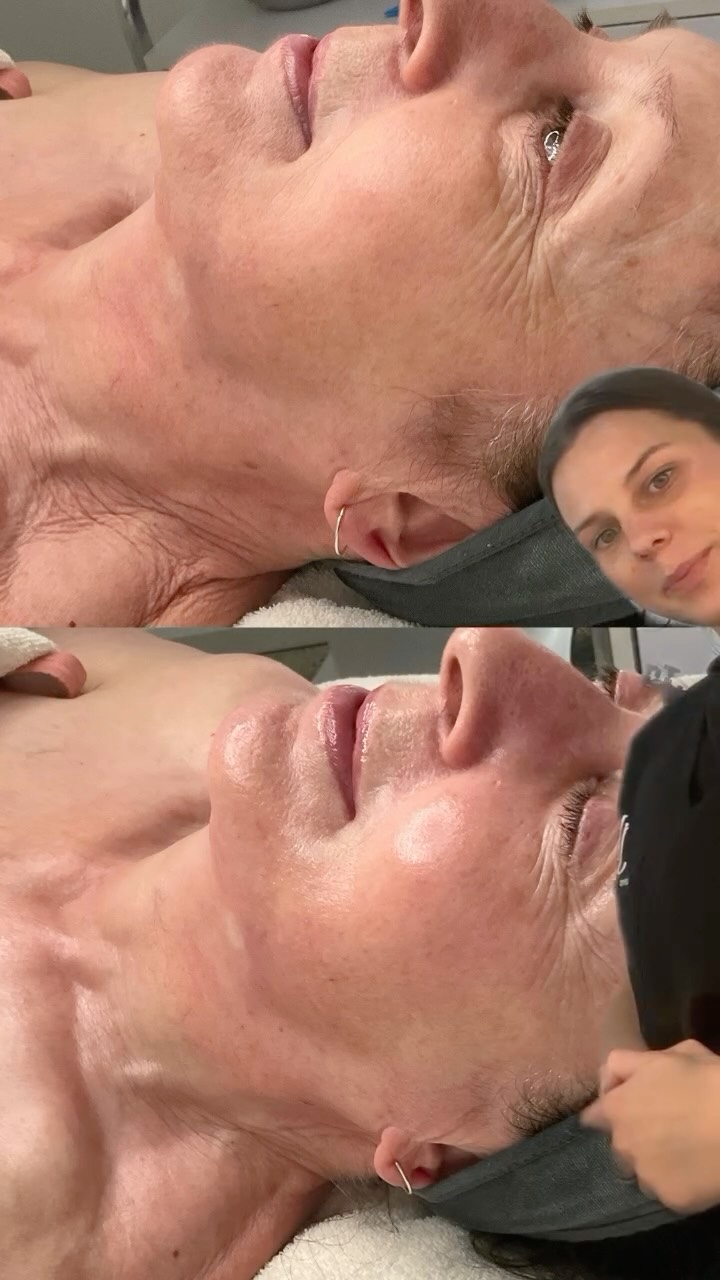 Been thinking about RF Skin Tightening? This is your sign 💘