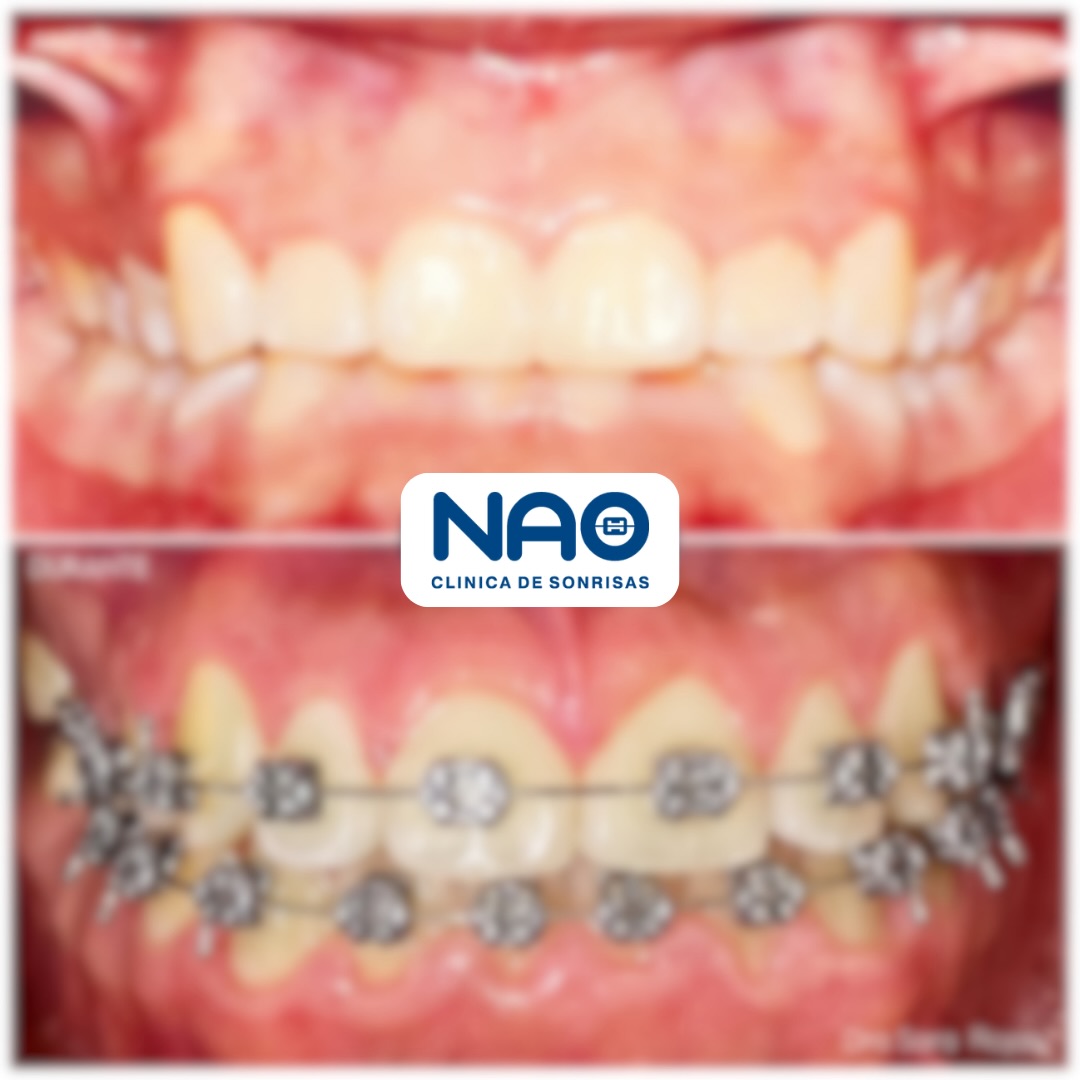 👉Tratamiento realizado: Ortodoncia
Corrigiendo y generando:
✔️Felicidad y seguridad al sonreír.
✔️Mordida profunda anterior.
✔️Linea media superior e inferior centradas.
✔️Calidad de vida.
✔️Arcos dentales armónicos.
👩⚕️Dra. Sara Rojas
📍Cali | Palmira
#odontologospalmira #odontologoscali #naoclinicadesonrisas #sonrieconconfianza #casodetransformacion