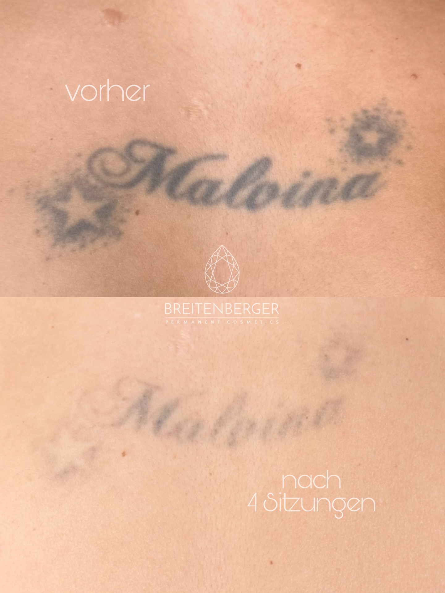 Tattooentfernung nach 4 Sitzungen ⚡️
Und schon kaum mehr sichtbar.
Bereit loszulassen?
Jetzt Termin sichern 🤩
TATTOOENTFERNUNG
PICOLASER