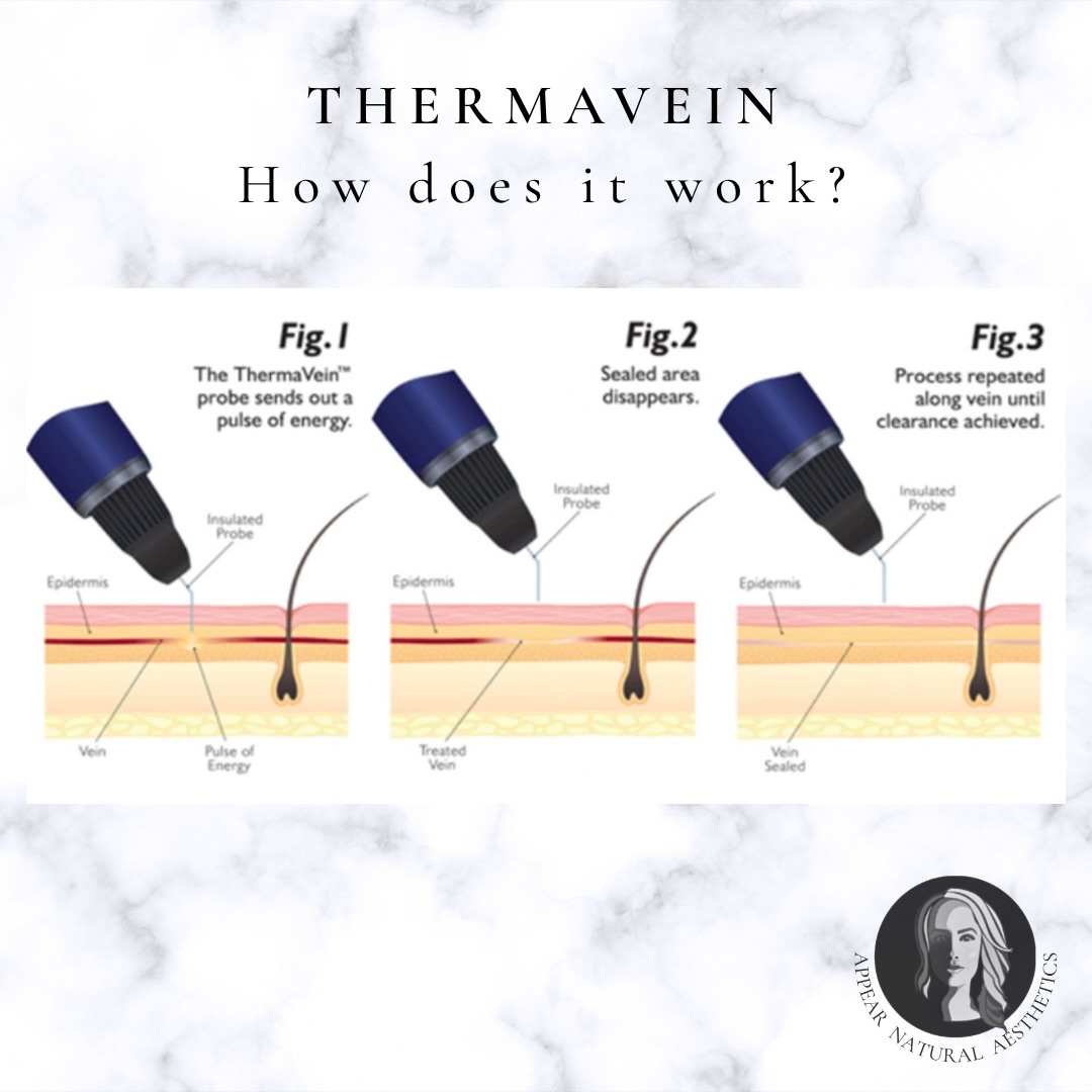 .
âš ððð ð¿ððð ððððððŒðððð ðððð? âš
Thermavein is an advanced, non-invasive treatment designed to safely and effectively treat thread veins (also known as spider veins), as well as skin tags and other minor vascular blemishes.
Using a very fine insulated probe, a precise high-frequency micro-current is applied directly to the surface of the skin. This creates a tiny, controlled burst of heat that targets the unwanted vein without damaging the surrounding tissue. The heat causes the vein wall to collapse and seal instantly, stopping blood flow through it. The treated vein is then naturally broken down and reabsorbed by the body over time.
One of the biggest benefits of Thermavein is that results can often be seen immediately, with continued improvement as the skin heals. The treatment is quick, requires no injections, and involves minimal downtime â making it a popular choice for delicate areas such as the face.
A simple, precise solution for clearer, more confident skin ð«
â¬
ïž Swipe for before / after results.
ð www.appearnaturalaesthetics.com
ð 07423 109237
ð§ info@appearnaturalaesthetics.com
ð· POA
ðHayes, Bromley BR2 7EB