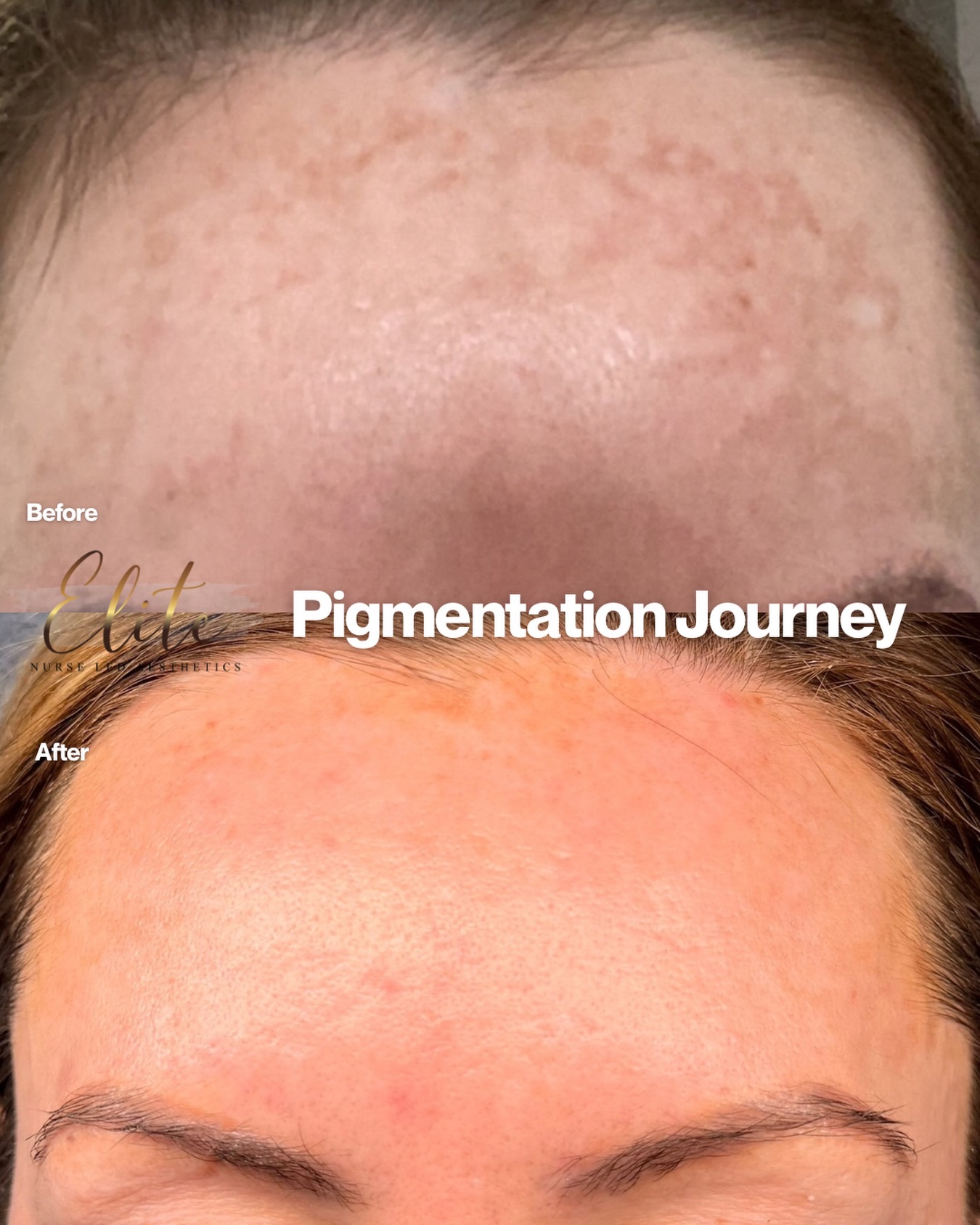 ✨ Pigmentation Journey: Nurse-Led. Bespoke. Results-Driven. ✨
Post-pregnancy hormonal changes can trigger stubborn pigmentation and melanin flare-ups that won’t respond to skincare alone. This is a common but complex condition — and it requires a medical, prescriber-led approach, not generic treatments.
👩⚕️ Nurse Prescriber–Led Assessment
Every plan begins with a detailed skin and medical consultation. As nurse prescribers, we assess hormonal triggers, skin behaviour, and risk factors to create a fully bespoke treatment pathway — safely and effectively.
💡 Your personalised treatment plan included:
🧪 Prescription-Grade Melanin Inhibitors
Target excess pigment production at the source, calm overactive melanocytes, and reduce the risk of rebound pigmentation.
🔥 CO₂ Laser
Treats deeper pigment, resurfaces the skin, stimulates collagen, and improves tone and texture at multiple skin levels.
💧 Hydrafacials
Support barrier repair, enhance hydration, and optimise skin health between laser sessions
#EliteNurseLedAesthetics
#WakefieldAesthetics
#WakefieldSkinClinic
#WakefieldBeautyClinic
#AestheticsWakefield