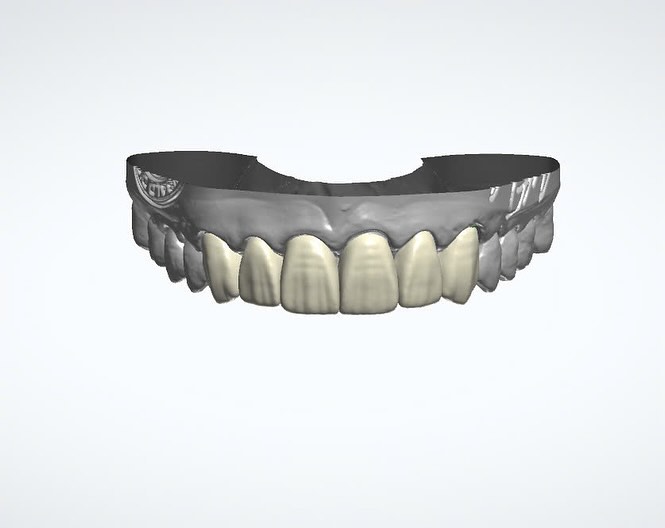 Anterior design with 3Shape #SmileMakeover #CosmeticDentistry #DentalLab #SmileDesign #OralHealth #DentalCare #DentistryWorld #ToothRestoration #Prosthodontics #DentalTechnician #DentalArt #DentalWork #DentalTechnology #LabMadeSmiles #DentalRestorations #DentalCeramics #DentalLabLife #CustomSmiles #HealthySmile #SmileGoals #BeforeAndAfter #CrownYourSmile #CeramicRestorations #Crownifysmiles #Crownify #Crownifydentallab #crownifydental #3shapedesign #3shape #digitaldesign