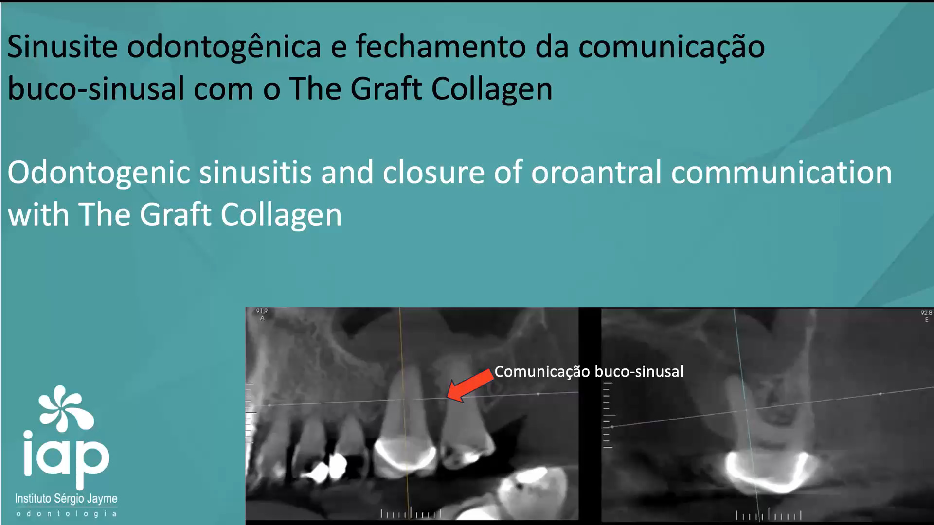 Sinusite odontogênica e fechamento da comunicação
buco-sinusal com o The Graft Collagen
Odontogenic sinusitis and closure of oroantral communication
with The Graft Collagen
A sinusite odontogênica é uma infecção de origem dentária que se manifesta no seio maxilar. Porém, por não ser diagnosticada da forma correta, muitas vezes é tratada como outros tipos de sinusite, o que não resolve os sintomas apresentados pelo paciente.
Corresponde aproximadamente por 10% a 12% dos casos de sinusite maxilar.
O diagnóstico da sinusite odontogênica envolve o exame clínico e o uso de imagens de tomografia computadorizada e o seu tratamento consiste, na eliminação do fator causal de origem dentária.
Esse vídeo, mostra uma técnica de como resolver o problema da sinusite odontogênica obliterando a comunicação buco-sinusal com o biomateral The Graft Collagen.
Após 5 meses, instalação de implante com o uso da Osseodensificação a 1500 rpm no sentido anti-horário simultâneo a um enxerto ósseo no seio maxilar via crista óssea.
Bibliografia:
Mehra P, Murad H. Maxillary sinus disease of odontogenic origin. Otolaryngol Clin North Am. 2004;37:347-64.
Lechien JR, Filleul O, Araujo PC, Hsieh JW, Chantrain G, Saussez S. Chronic Maxillary Rhinosinusitis of Dental Origin:
A Systematic Review of 674 Patient Cases. Int J Otolaryngol. 2014; 2014:1-9.
Lee KC, Lee SJ. Clinical features and treatments of odontogenic sinusitis. Yonsei Med J. 2010;51(6):932-7.
Guerra-Pereira I, Vaz P, Faria-Almeida R, Braga AC, Felino A. CT maxillary sinus evaluation-A retrospective cohort study.
Med Oral Patol Oral Cir Bucal. 2015;1(20):e419-26.
Sheikhi M, Pozve NJ, Khorrami L. Using cone beam computed tomography to detect the relationship between the periodontal
bone loss and mucosal thickening of the maxillary sinus. Dent Res J (Isfahan). 2014;11(4):495–501.
Goller-Bulut D, Sekerci AE, Kose E, Sisman Y. Cone beam computed tomographic analysis of maxillary premolars and molars to
detect the relationship between periapical and marginal bone loss and mucosal thickness of maxillary sinus.
Med Oral Patol Oral Cir Bucal. 2015;20(5):e572-9.
#sinusite #sinusiteodontogenica #seiomaxilar #implante #cu