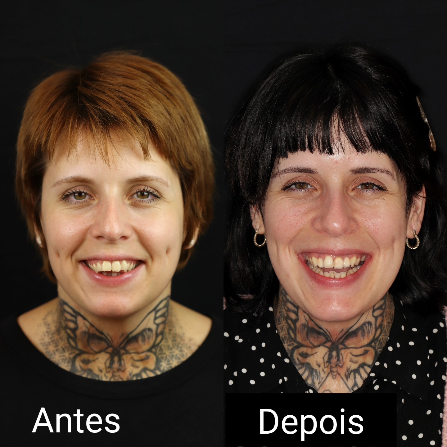 Sim, este é o início do tratamento!
Apenas 1 mês após a cirurgia e a transformação já é visível — antes mesmo do aparelho!
Como é possível?
Combinando cirurgia ortognática 𝗺𝗶𝗻𝗶𝗺𝗮𝗺𝗲𝗻𝘁𝗲 𝗶𝗻𝘃𝗮𝘀𝗶𝘃𝗮 e o protocolo 𝙎𝙪𝙧𝙜𝙚𝙧𝙮 𝙁𝙞𝙧𝙨𝙩.
Uma intervenção rápida, em regime de ambulatório, com apenas 5-7 dias de repouso...
E o resultado?
𝗨𝗺 𝗻𝗼𝘃𝗼 𝗽𝗲𝗿𝗳𝗶𝗹 𝗳𝗮𝗰𝗶𝗮𝗹, 𝘂𝗺𝗮 𝗻𝗼𝘃𝗮 𝗼𝗰𝗹𝘂𝘀ã𝗼 — 𝗲 𝘂𝗺𝗮 𝗽𝗮𝗰𝗶𝗲𝗻𝘁𝗲 𝗺𝗼𝘁𝗶𝘃𝗮𝗱𝗮 𝗰𝗼𝗺𝗼 𝗻𝘂𝗻𝗰𝗮 𝗽𝗮𝗿𝗮 𝗼 𝗿𝗲𝘀𝘁𝗼 𝗱𝗮 𝗷𝗼𝗿𝗻𝗮𝗱𝗮 𝗼𝗿𝘁𝗼𝗱𝗼𝗻𝘁𝗶𝗰𝗮!