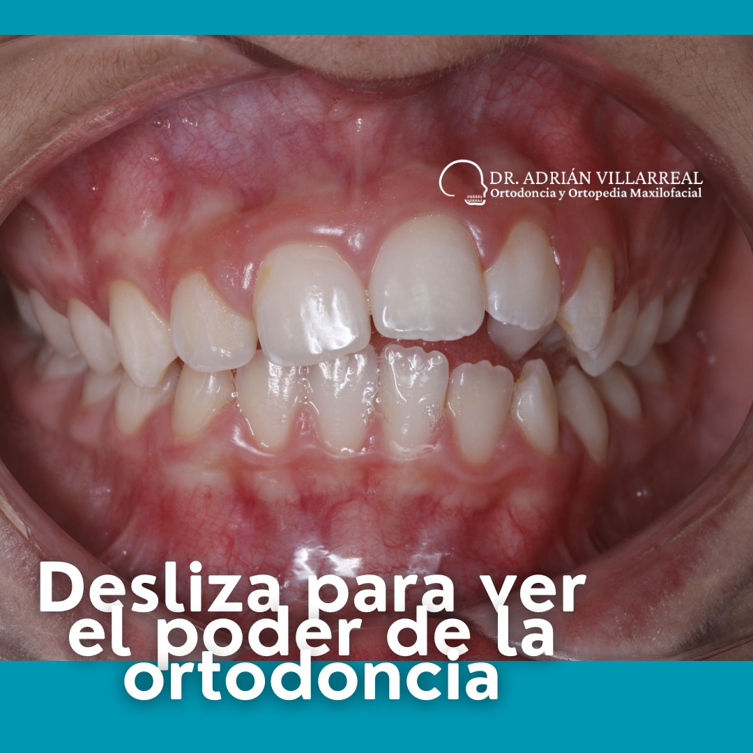 ⏭️ El poder de la ortodoncia✨ Agenda tu valoración por mensaje! 📲
.
.
.
.
.
.
.
UANL Ced. Prof. 12948881
UANL Ced Maestria: 14532598
COFEPRIS: 2419032002A00440
.
.
.
#dentistamty
#odontologomty #sonrisaperfecta #ortodonciaméxico