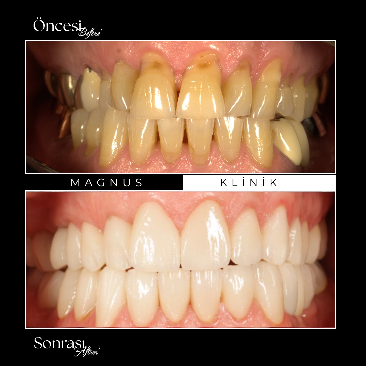 * Bu paylaşım bilgilendirme amaçlıdır; tanıtım ve reklam niteliği taşımaz.
* Paylaşım yönetmelik gereği yoruma, beğenilere kapatılmıştır.
* Paylaşılan görüntüler, kliniğimizde tedavi gören hastamızın açık rızası alınarak yayımlanmıştır.
* Bu içerik, 12.11.2025 tarihli Resmî Gazete’de yayımlanan Sağlık Hizmetlerinde Tanıtım ve Bilgilendirme Faaliyetleri Hakkında Yönetmelik’in 7. maddesine uygun olarak hazırlanmıştır.
* Her cerrahi veya girişimsel işlemde sonuçlar kişiden kişiye değişiklik gösterebilir. İşlem öncesinde hekiminizden detaylı görüş almanız önerilir.
✨ 𝐌𝐚𝐠𝐧𝐮𝐬 | 𝐺𝑢̈𝑙𝑢̈𝑠̧𝑢̈𝑛 𝑂̈𝑡𝑒𝑠𝑖𝑛𝑑𝑒 🦷✨