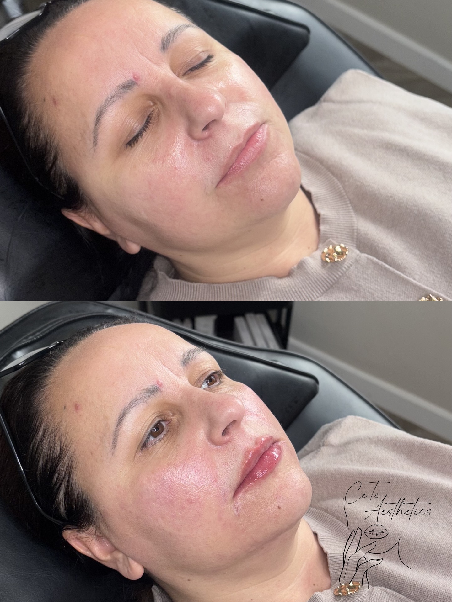 ✨ FULL FACE TWEAKMENTS ✨
Full face dermal filler isn’t about “adding more”… it’s about restoring harmony, structure, and confidence 💉
As we age, we lose volume in key areas of the face. This can lead to sagging, hollowing and deeper lines. Our full face approach treats the face as a whole, not just one area.
💉 Areas we may treat:
• Cheeks – restore lift & contour
• Chin – improve profile & balance
• Jawline – define & sculpt
• Lips – enhance shape & hydration
• Nasolabial folds – soften lines
• Marionette lines – reduce heaviness
✨ WHY FULL FACE TWEAKMENTS?
• Creates natural, balanced results
• Avoids the “overfilled” look
• Tailored to YOUR facial structure
• Long-lasting, subtle rejuvenation
PACKAGE OPTIONS:
• 3ml – Refresh & subtle enhancement
• 4ml – Balanced rejuvenation
• 5ml+ – Advanced sculpt & contour
Every treatment is fully customised following an in-depth consultation to ensure the most flattering, natural result.
Please book your appointment in advance
www.ceteaesthetics.co.uk
#aesthetics #scunthorpebusiness #lipfillerlincolnshire #scunthorpelipfiller #dermalfiller