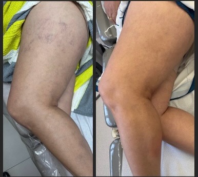 Autoestima recuperada - Tratamento de veias reticulares e vasinhos com a utilização de Laser transdérmico e escleroterapia.