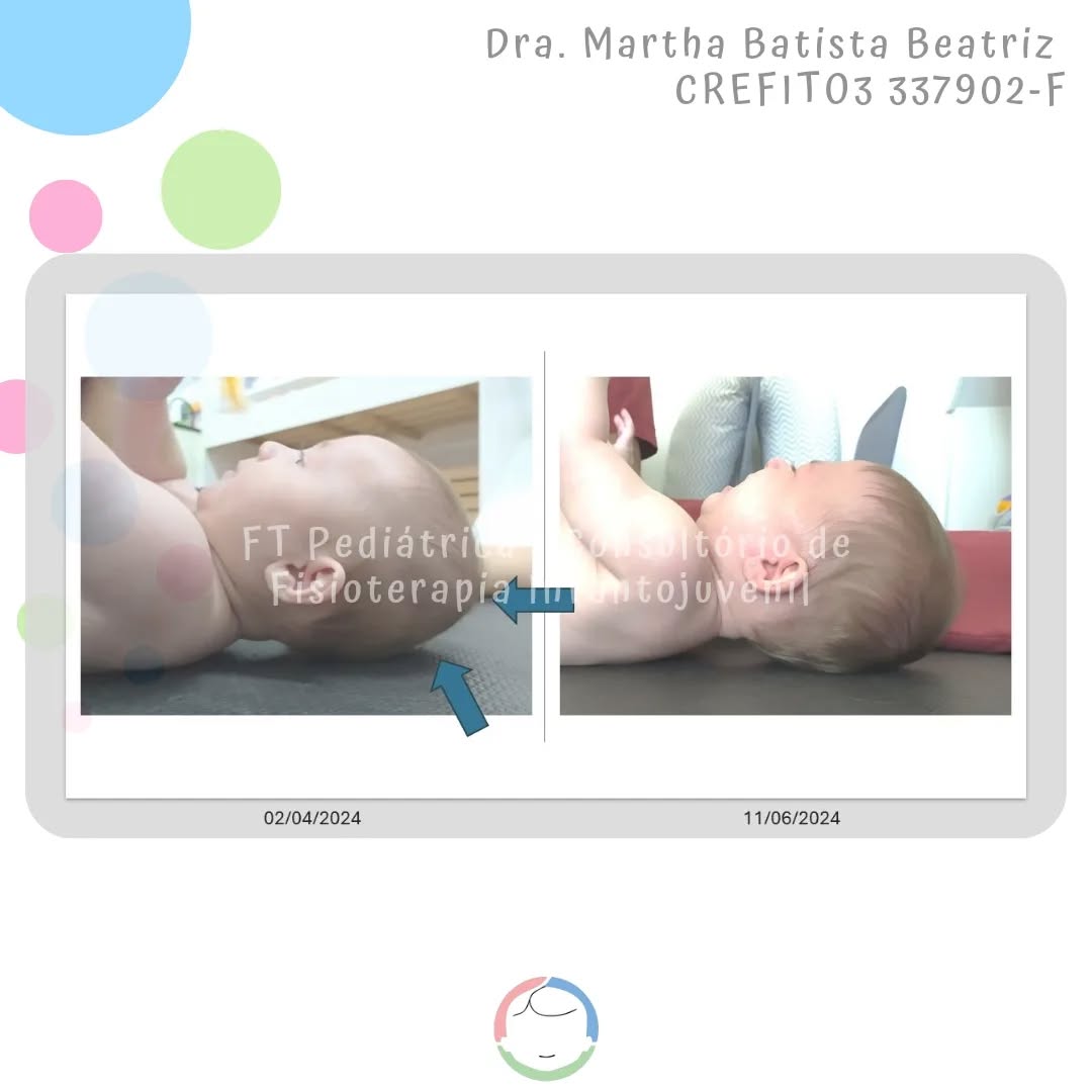 Tem gêmeas dando tchau para o torcicolo e assimetria.
Seguimos firmes no tratamento, mas impossível de não ficar encantada com o resultado 🤩
Gemelar 1
Fisioterapeuta @martha_bbeatriz
Método De Setti - em formação
@carolinadesetti