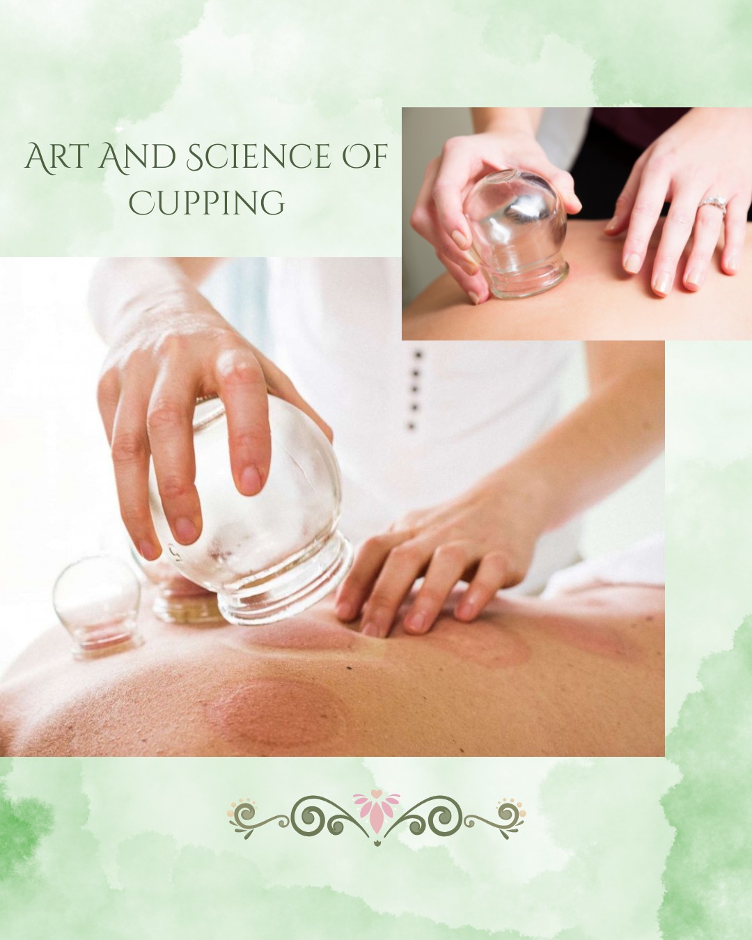 Have you ever wanted to try cupping?
We would love to assist you on your healing journey!
China is famous for cupping, and its use there dates back thousands of years. The earliest record of cupping in China was from the Han Dynasty (206 BC- 220 AD). Back then, cupping was applied using cattle horns or cross sections of bamboo. Now, Chinese Medicine Practitioners generally use round glass or plastic cups.
Traditionally, all cupping involved a flammable substance set on fire and placed in a cup. As the fire goes out, the cup is turned upside down on your skin, creating a vacuum.
Wet cupping involves bloodletting enhanced by the suction of the cups. This is thought to draw out thick, stagnant blood, generating healing through improved blood flow.
Dry cupping is the more commonly used method in most modern clinics today and is any type of cupping that doesn't involve a puncture to draw blood.
A convenient cupping tool used by many acupuncturists today uses a pump instead of fire to create the vacuum. This style allows for the use of smaller cups to work with bony joints and even face muscles.
Some therapists also use silicone cups, which are easily maneuvered with a squeeze of the hand to create the desired level of suction.
Cupping is understood in TCM to assist with qi and blood flow. It also opens the pores to draw out pathogenic factors such as wind, cold, damp and heat. Biomedical research has found that, cupping does, in fact, increase local blood flow through microcirculation and capillary cell repair, and wet cupping has been shown to help remove toxins from the blood.
#acupuncture #traditionalchinesemedicine #tcm #chinesemedicine #healing #cupping #cuppingmedicine #hollistichealing #wellnessjourney #painfree #california #pleasanthill #contracostacounty #healingjourney #smallbusiness #womanownedbusiness #booknow #ginamarksacupuncture