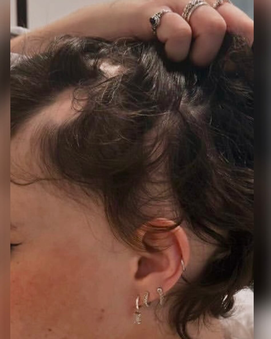 La Pelade !
Confiance et Féminité grâce à sa dermofusion…
Superbe 💌
#pelade #dermofusionfemme #liguecancersuisse #liguecancerfribourg