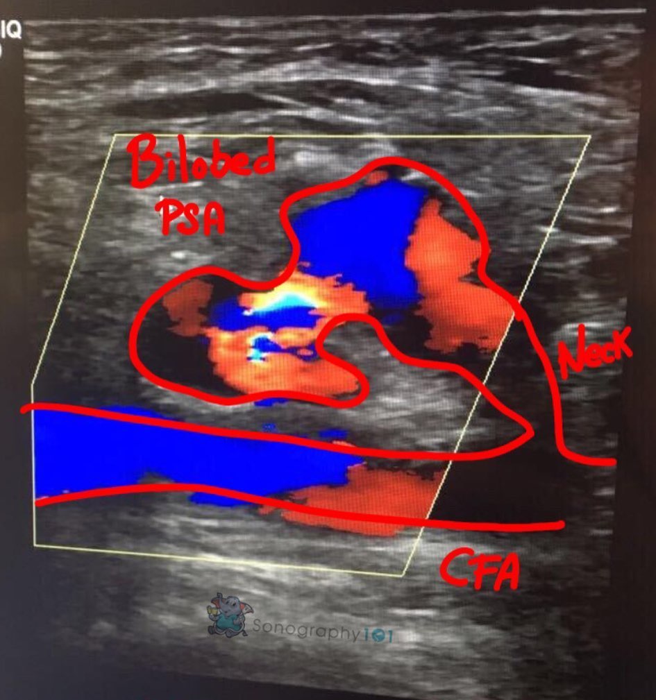Beautiful images of a bilobed pseudoaneurysm (PSA) by @jordyjord . Great job girl 🤗