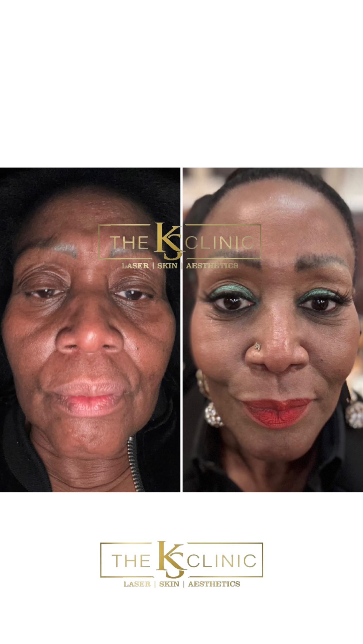 Endopulse / Endolift Results.
Proof - 6 weeks post endopulse / endolift.
What we did - Full face & Neck Endo treatment.
Who it's for - If you've tried everything for skin tightening and or you have lost weight and or ageing.
“read this."
• "Endopulse result after 1 session over 6 weeks."
• "Client's main goal: tighten / lift / de-puff / smooth texture / improve laxity." Due to weight loss journey.
• "What you're seeing: jawline looks sharper / under-eye looks less hollow / skin looks firmer, tighter and lifted"
If you’ve tried everything would like to discuss your skin tightening DM “Endo”
Alternatively book your consultation today. Link in bio.
@theksclinic #endolift #skintightening #skinlifting #facelift #birmingham