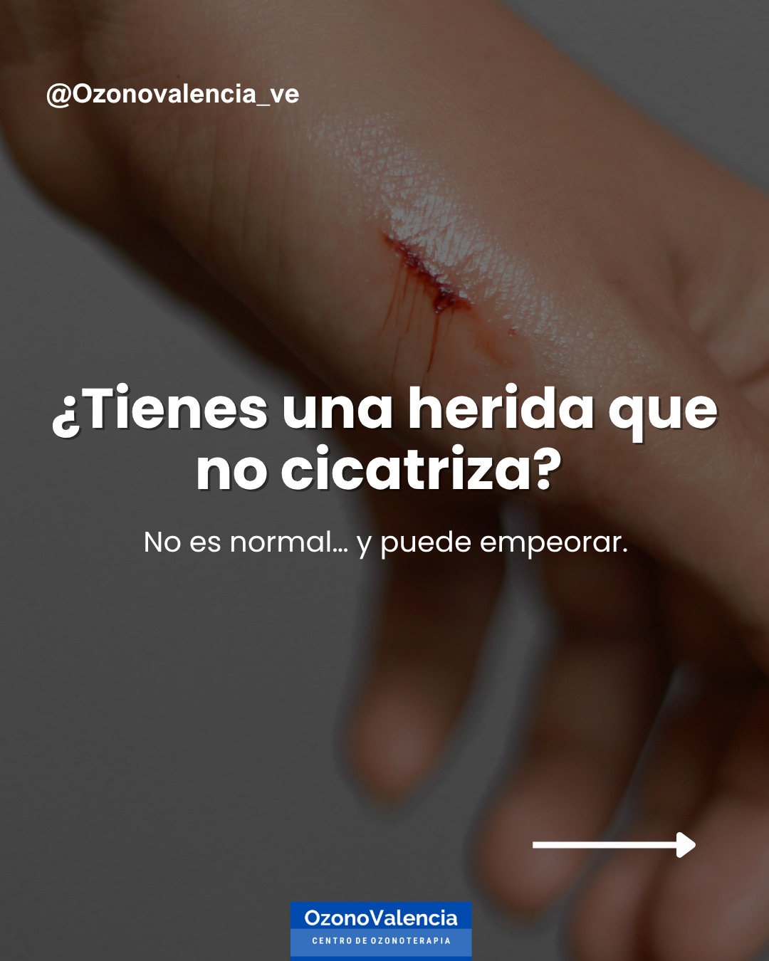 Una herida que no cicatriza no debe ignorarse.
Detrás puede haber problemas de circulación, infección o procesos inflamatorios que impiden la recuperación del tejido.
Actuar a tiempo hace la diferencia entre una recuperación adecuada o una complicación mayor.
La ozonoterapia contribuye a mejorar la oxigenación, controlar infecciones y acelerar la regeneración.
📩 Contáctanos y recibe una valoración médica.
#Cicatrización #HeridasCrónicas #Salud #Ozonoterapia #MedicinaRegenerativa
