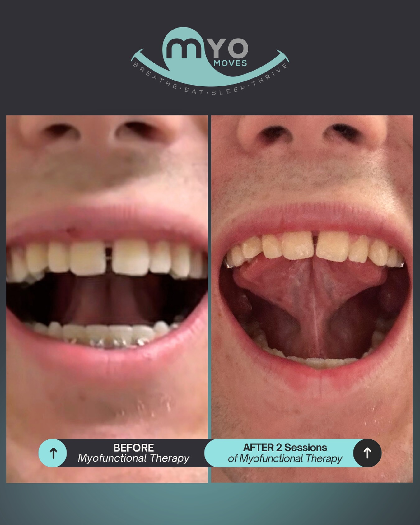 Even early in treatment, function can start to shift!
This is after just 2 sessions of myofunctional therapy, and you can already see improved tongue mobility and tongue suction. More importantly, we’re beginning to train the tongue to live where it’s meant to be - resting on the roof of the mouth.
That’s because we’re not just “waiting for results”… we’re actively targeting the habits and patterns driving dysfunction from day one.
Small, intentional changes → better muscle coordination → real functional progress.
Because when the tongue is in the right place and working the right way, everything else has the potential to follow.
Ready to address the root, not just the symptoms? Comment “MYO” to get started. 👅