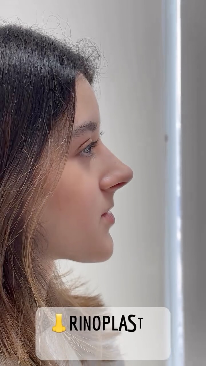 🔹 La Rinoplastia Personalizada se adapta a tu rostro, tus rasgos y tus expectativas. Natural, armónica y única.
🔹Evolución a un mes de Cirugía Nasal Estética y Funcional.
🔹 Gracias a mi excelente paciente por su confianza y permitir compartir su resultado.
🔹”Made by hand. Crafted with passion”
🧑⚕️ Dr. Guillermo Guerra Gil de Leyva
🏥 Hospital Ángeles Valle Oriente
📱 81-1252-0132
🎓Universidad de Monterrey
👃 Rinoplastia Estética y Funcional
🚫 No taponamiento
Cédula Profesional: 3070499
Cédula Especialista: 4503273
No. Certificación CONACEM: GUG-1748/04
Aviso de Publicidad COFEPRIS: 2419032002A00111
❕Paciente autoriza difusión de imágenes con fines académicos e informativos.
❕Los resultados finales se pudieran observar hasta un año de la cirugía y dependerá tanto del compromiso del cirujano como del paciente, así como del tipo de cirugía, tipo de piel, cuidados post-operatorios, etc.
#RinoplastiaPersonalizada #TuNarizTuEstilo
#rinoplastia #rhinoplasty #septoplastia septoplasty rinoseptumplastia rhinoseptoplasty nosejob nose nosesurgery tabiquenasal otorrinolaringologia entsurgery cirugianasal cirugiatabique cirugiaesteticanasal
belleza confianza autoestima
cosmeticsurgery
otorrinolaringologiamonterrey otorrinomonterrey beforeandafter antesydespues
estructuredrhinoplasty
rinoplastiaestructurada
rinoplastiaultrasonica
ultrasonicrhinoplasty