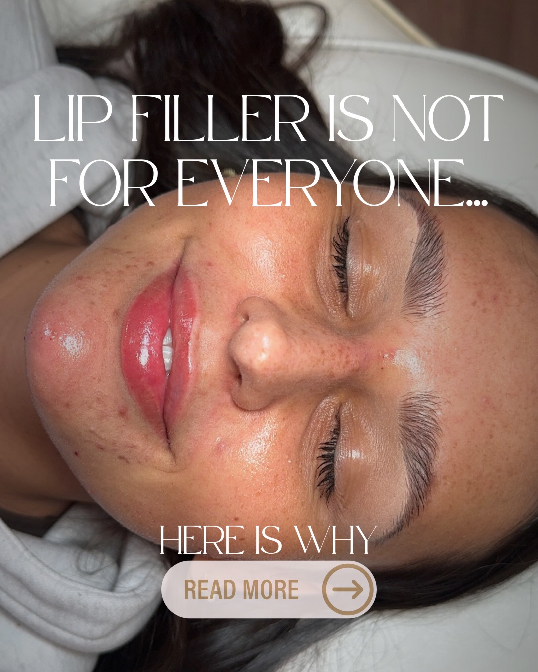 The reason you may not be suitable for lip filler - YET👄💉
I always like to be really open and transparent in clinic so clients get the best possible outcome, not just more product.
This is why it is so important to choose your aesthetics practitioner carefully - I will never give you a treatment I don’t believe will benefit you!
#aestheticspractitioner #sunderlandaesthetics #aestheticsclinic #lipfiller #lipflip