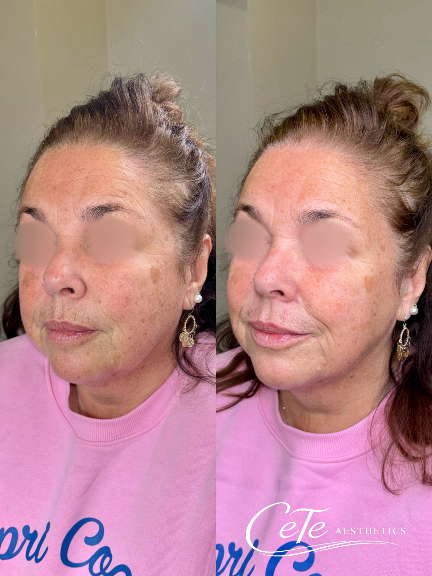 A personalised dermal filler package created to subtly rejuvenate and rebalance the face.
🗓️ With May availability becoming limited, early booking is advised to avoid disappointment
📍CeTe Aesthetics, 278 Ashby High Street, DN162RX
📲 www.ceteaesthetics.co.uk
Medical Aesthetics Clinic & Training Academy
——
#scunthorpeaesthetics #dermalfiller #facialrejuvenation #scunthorpebusiness #lincolnshireaesthetics