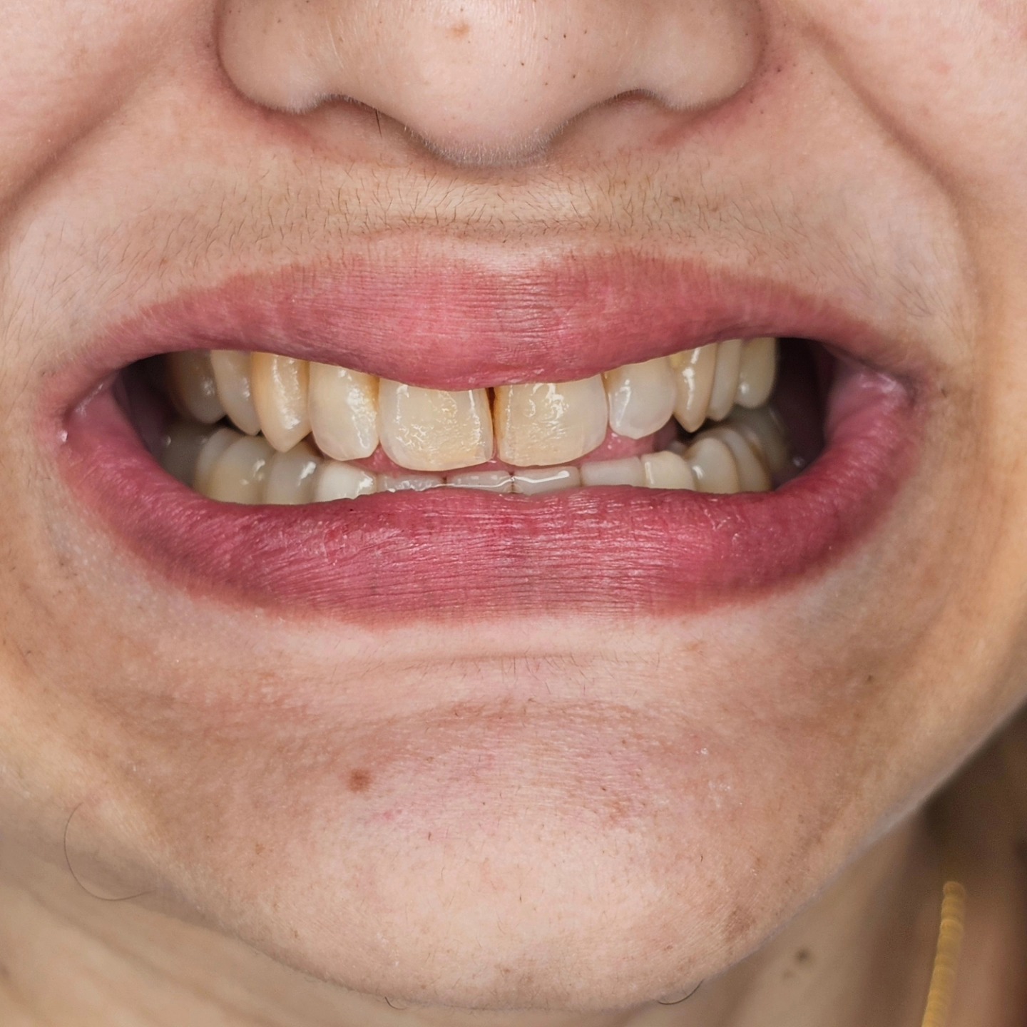 Hygiene is two thirds of health.
The visible resilts in comparing the pre op and post op images of a patient who underwent deep scaling and root planing followed by laser assisted new attachmemt procedure . A zirconia bridge for the lower front teeth replacement and splinting as well.
Sethu's Dental House
Precise Pleasant and Aesthetic Dentistry By Dr. Sethuraman Ramadoss and team
#Zirconia #laserdentistry #lanap #laser #americandiamond