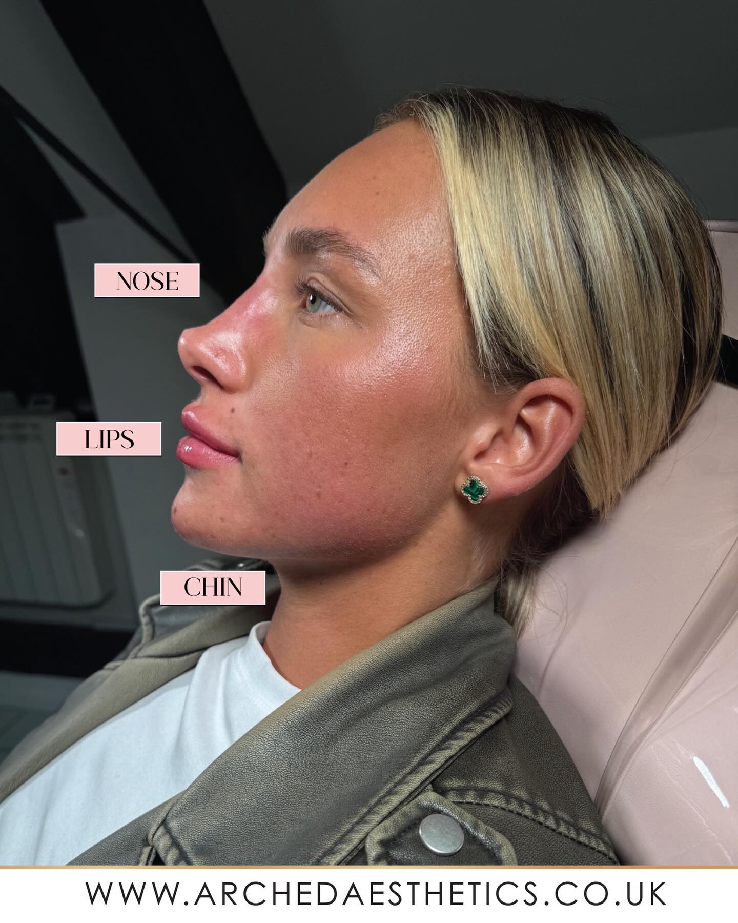 
✨ 𝐒𝐢𝐝𝐞 𝐏𝐫𝐨𝐟𝐢𝐥𝐞 𝐄𝐧𝐡𝐚𝐧𝐜𝐞𝐦𝐞𝐧𝐭 𝐏𝐚𝐜𝐤𝐚𝐠𝐞 ✨
A balanced side profile can make a huge difference to overall facial harmony. This client had a dermal filler package using a combination of chin, lip, and nose filler to create smoother contours and better proportions throughout.
💉 𝗪𝐡𝐚𝐭 𝐰𝐚𝐬 𝐭𝐫𝐞𝐚𝐭𝐞𝐝:
• Chin filler – to improve projection and define the jawline
• Lip filler – to enhance shape and support the profile
• Nose filler – to smooth the bridge, flick the tip and refine the profile
🎯 𝗪𝐡𝐲 𝐜𝐨𝐦𝐛𝐢𝐧𝐞 𝐭𝐫𝐞𝐚𝐭𝐦𝐞𝐧𝐭𝐬?
Treating multiple areas together helps create facial balance, rather than focusing on just one feature. Small, strategic enhancements can make the side profile look more harmonious and refined.
✨ Always performed by a qualified professional with a tailored treatment plan for natural looking results.
__________________________
Get in touch 👇🏽
𝐃𝐌 𝐔𝐒 𝐅𝐎𝐑 𝐄𝐍𝐐𝐔𝐈𝐑𝐈𝐄𝐒
GIFT VOUCHERS AVAILABLE
SWIPE FOR CLINIC DATES
⭐️ 5 STAR GOOGLE REVIEWS
💻 www.archedaesthetics.co.uk
📱 𝗪𝐇𝐀𝐓𝐒𝐀𝐏𝐏 07517416782
📧 hello@archedaesthetics.co.uk
#lipfillerplymouth #dermalfillerplymouth #aestheticscallington #dermalfillercallington #aestheticsliskeard