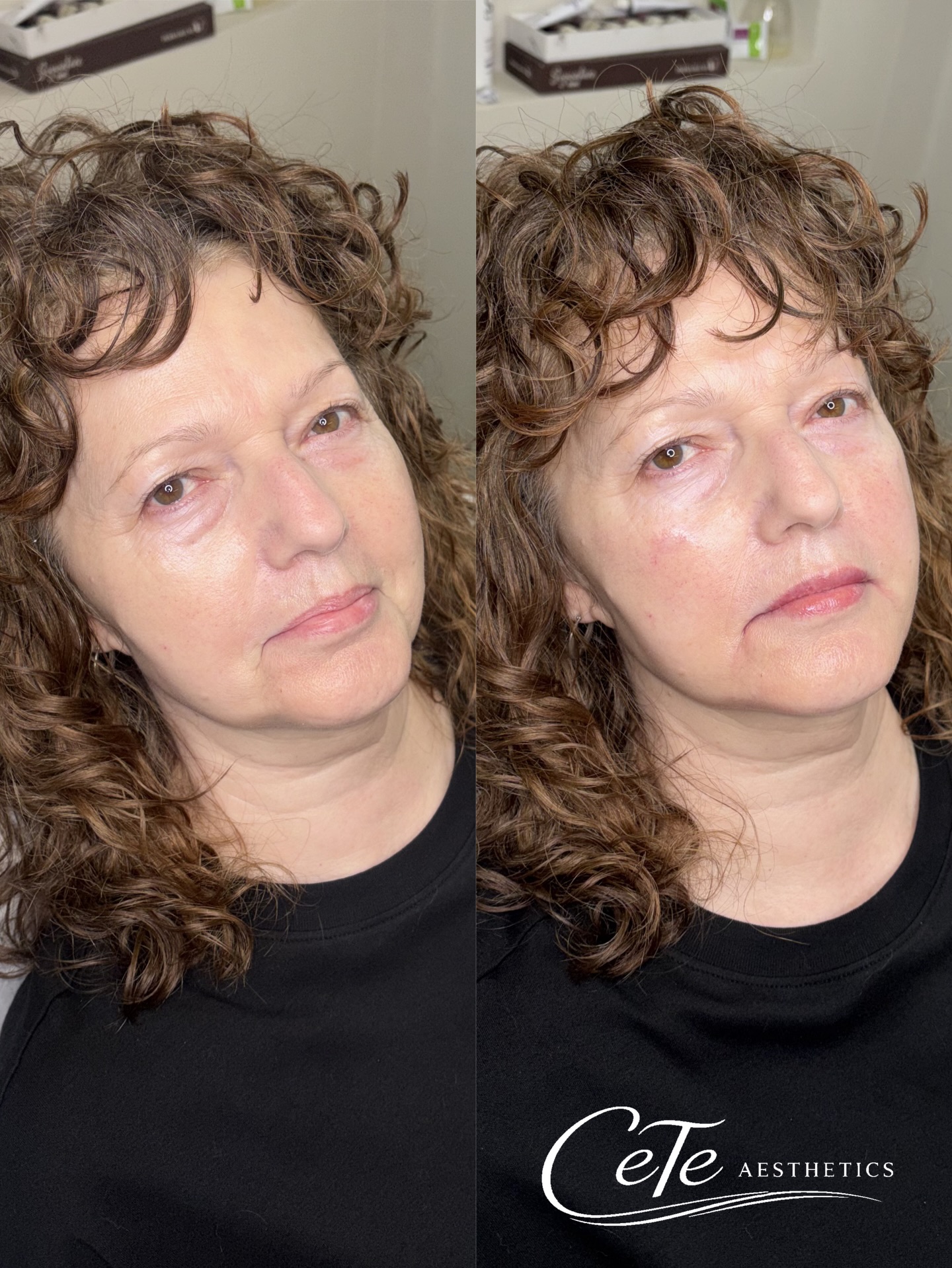 Treatment: Dermal Filler Package
📅 Availability Update
Our next available appointments for a dermal filler packages are in May.
We have just 2 remaining 1 hour appointments left for April before we are fully booked.
Please book in advance as we are unable to squeeze in anymore last minute appointments due to having no availability remaining 🤍