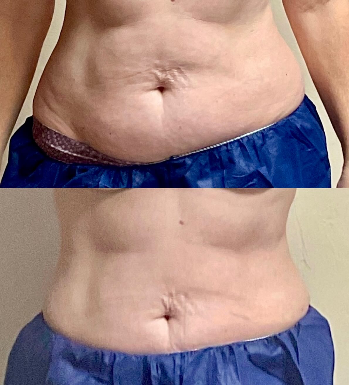 Real results—on real bodies.
We don’t chase perfection, we refine what’s already there.
CoolSculpting is designed to contour and enhance, not change who you are.
Subtle. Intentional. Effective.❄️