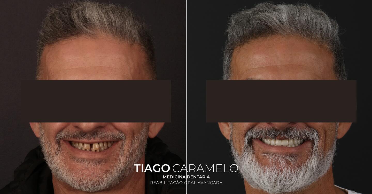 Mais um caso exemplificativo da técnica All-on-4 que permitiu a este paciente, com doença periodontal crónica generalizada, voltar a sorrir e mastigar com toda a comodidade!
—————————————————————————————
Another case showcasing the All-on-4 technique, which allowed this patient with generalized chronic periodontal disease to smile and chew comfortably again!
#allon4® #fixedteeth #oralrehabilitatition #maloclinic #malocliniceducation #aestheticdentistry