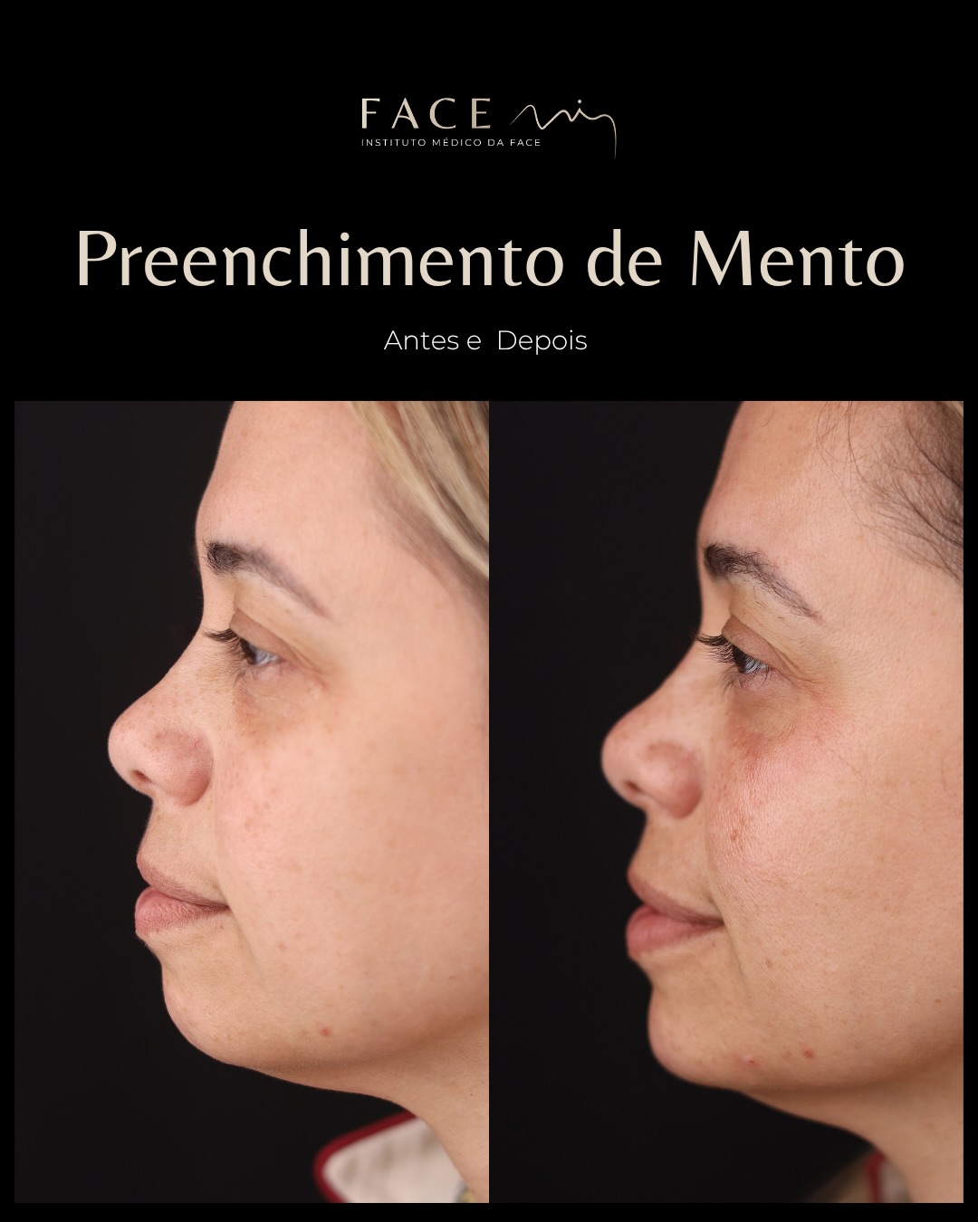O preenchimento do queixo tem a capacidade de equilibrar o perfil facial.
Com pequenas quantidades de ácido hialurónico conseguimos melhorar as proporções e definir o perfil de forma natural e segura.
Agende a sua consulta médica e descubra se este tratamento é indicado para si.
Os casos clínicos apresentados refletem o antes e depois de pacientes específicos. Cada pessoa é única e o resultado pode variar de paciente para paciente.
Todos os pacientes, antes de cada procedimento, passam por um processo de consulta médica de diagnóstico onde são avaliadas indicações, expectativas e motivações.
Registo ERS: 21236
Registo estabelecimento: E159774
Licença funcionamento: 21236/2022
#preenchimentoqueixo #retrognatiamandibular #facemiporto #medicinaesteticaporto #botoxporto
