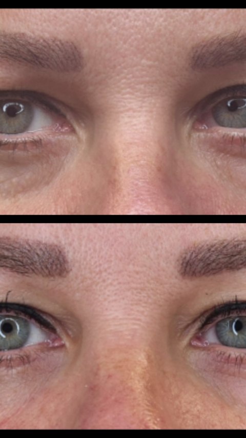 Illuma luna undereye skin booster & polynucleotides
#skinboosters #polynucleotides #peptides