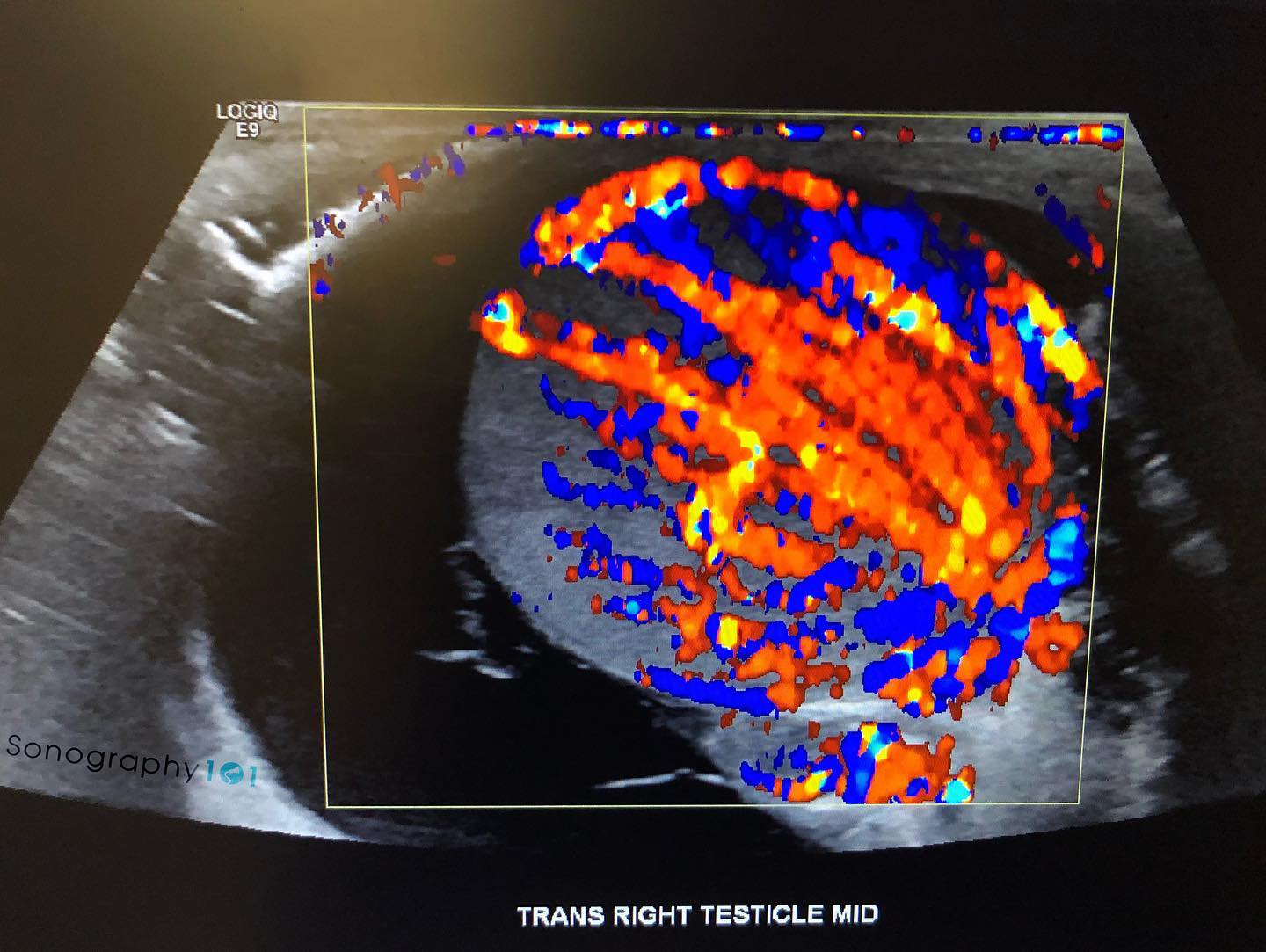What’s going on this week ? 🧐
What’s your best guess?
ANSWER: Epididymo-orchitis with hydrocele
#WhatsWrongWednesdays