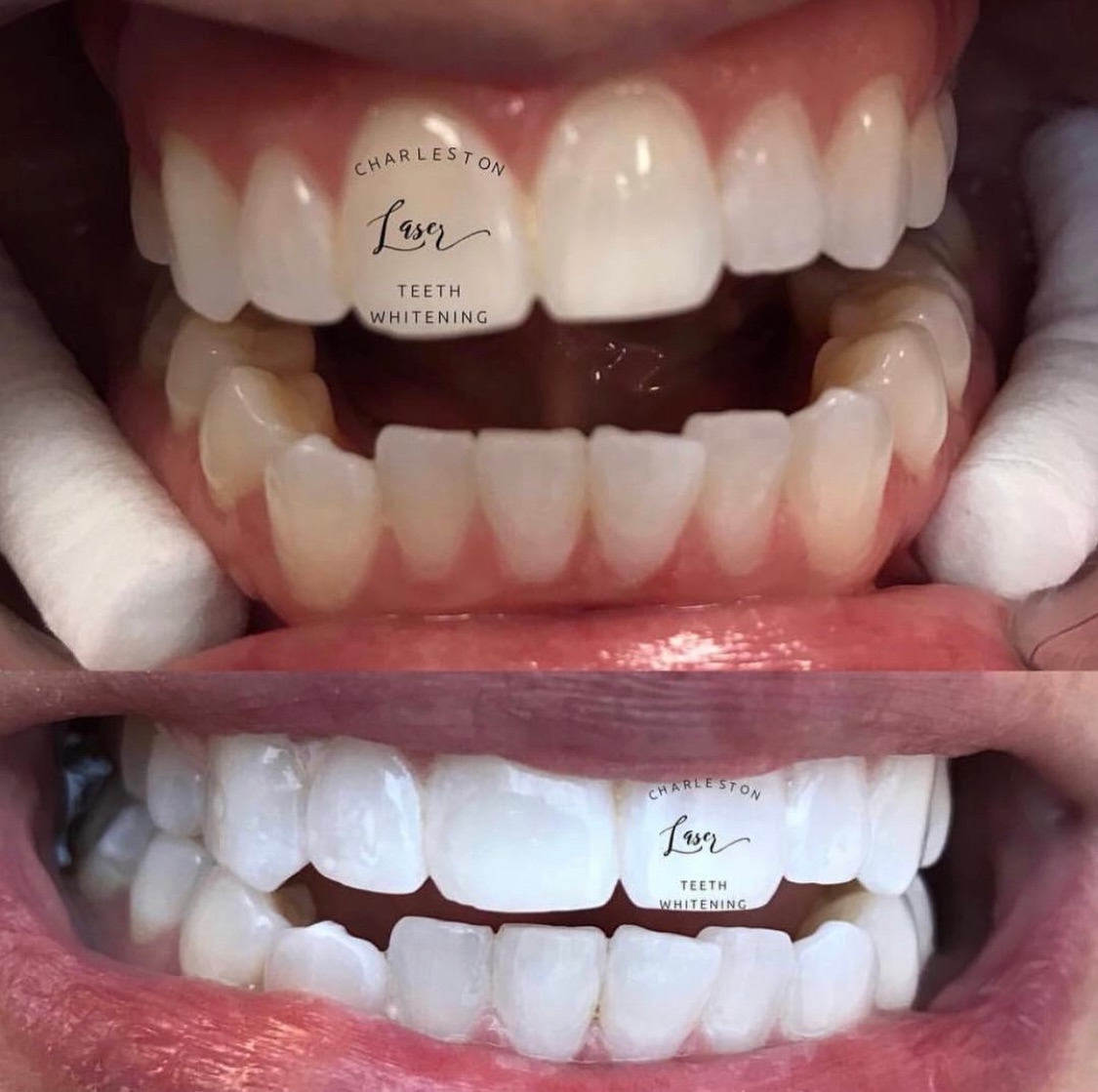 Bridge run ready! 🏃♀️🏃
Book your teeth whitening now!
www.CharlestonLaserTeethWhitening.com
#teethwhitening #charlestonteethwhitening #charleston #charlestonsc #charlestonlaserteethwhitening mountpleasant mountpleasantsc kiawahisland kiawahjamesisland westashley isleofpalms downtowncharleston sullivansisland johnsisland johnsisland northcharleston northcharlestonsc folly follybeach laserteethwhitening