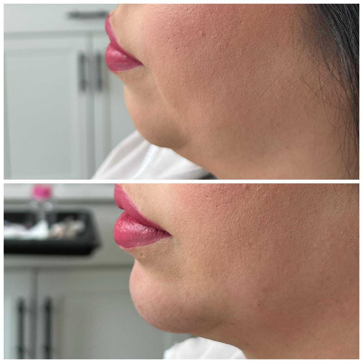 Chin Filler is a cosmetic treatment, where dermal filler is injected into the chin, to enhance shape, give projection and add balance with the rest of the face. ✨
Book a consultation to find out if this treatment is right for you🤍📆
El relleno de mentón es un tratamiento estético en el que se inyecta un relleno dé Ácido hialurónico en el mentón para mejorar su forma, proyección y equilibrio con el resto del rostro. ✨
Agenda, tu consulta hoy para ver si eres buena candidata para este tratamiento 🤍📆