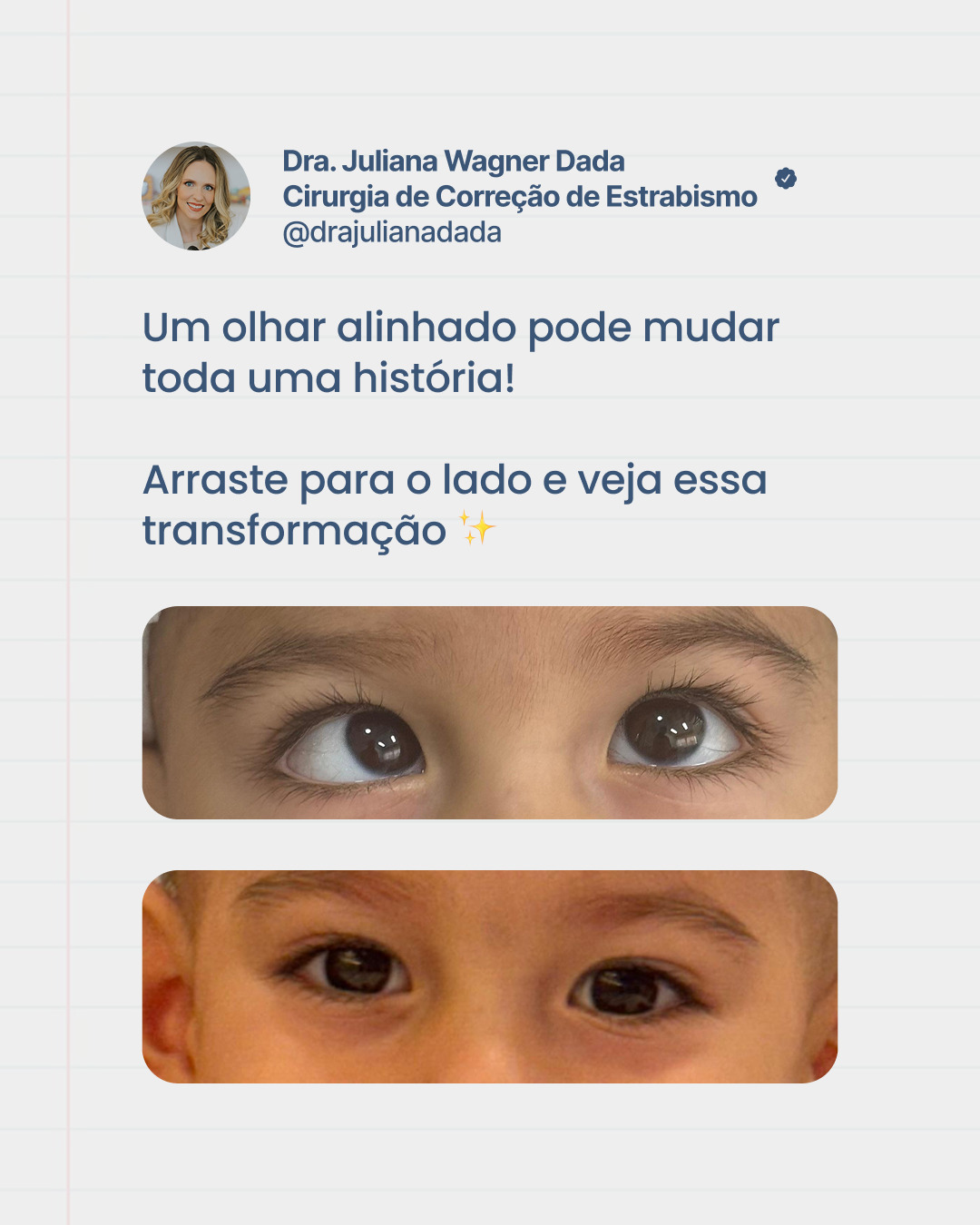 Nem sempre o estrabismo é apenas uma questão estética.
Nesse caso, estamos falando de um bebê com desafios desde o nascimento, onde o desalinhamento dos olhos também impactava o desenvolvimento neuropsicomotor.
Após a cirurgia, ele começou a engatinhar e já consegue se apoiar de pé. Isso mostra como o alinhamento ocular também influencia na forma como a criança interage com o mundo.
O tratamento precoce pode fazer toda a diferença no desenvolvimento visual e global.
Cada caso é único, mas agir no tempo certo abre novas possibilidades de evolução.
Dra. Juliana Wagner Dada
Referência em Estrabismo adulto e infantil
Especialista em Oftalmologia Pediátrica
CRM39665
RQE35215
#estrabismo #saudeocular #oftalmopediatria