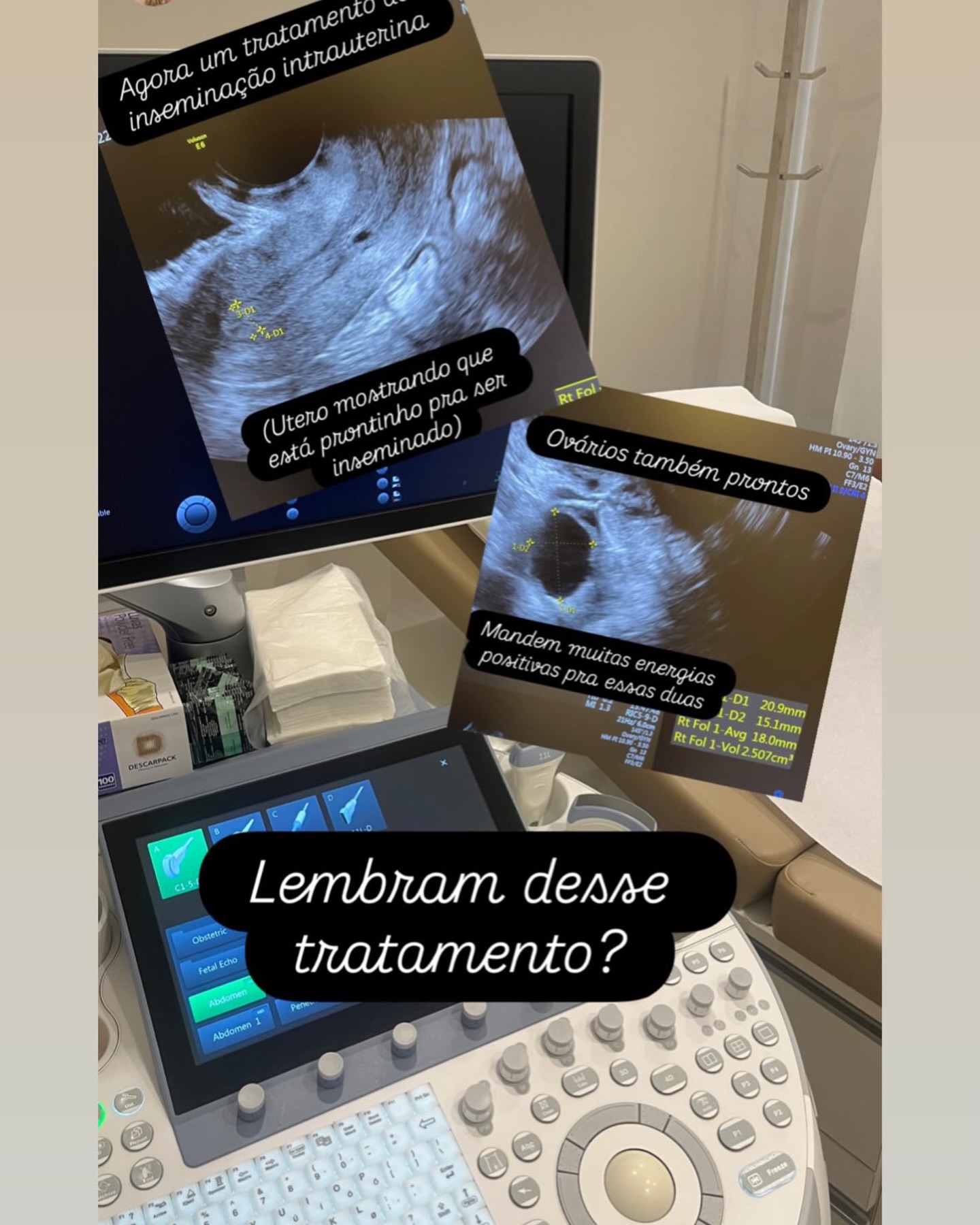 Inseminação intrauterina #inseminaçãoartificial #fiv #fertilizaçãoinvitro #reproduçãoassistida