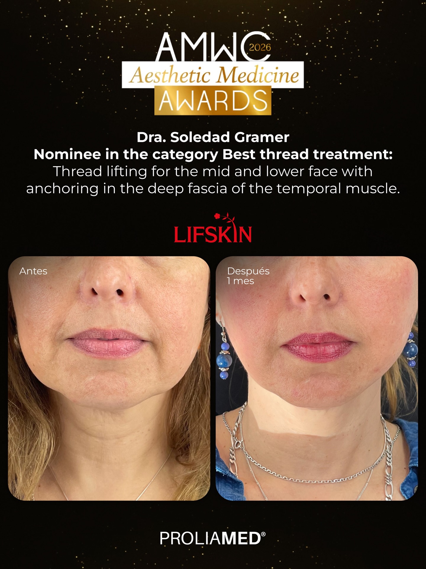 Felicitamos a nuestra doctora speaker la Dra. Soledad Gramer @dragramer por ser nominada dentro de las 3 mejores en su categoría Best Thread Treatment en los AMWC Aesthetic Medicine Awards 2026 🏆
Un reconocimiento a su excelencia, técnica y compromiso con la medicina estética.
El caso corresponde a un lifting de tercio medio e inferior del rostro, realizado con 10 hilos Molding Cog de Lifskin, logrando una reposición y definición armónica de los tejidos.
Las imágenes muestran el antes y el resultado al mes del procedimiento.
¡Un logro totalmente merecido! ✨
#Proliamed #Lifskin #AMWC2026 #ThreadTreatment #MedicinaEstética