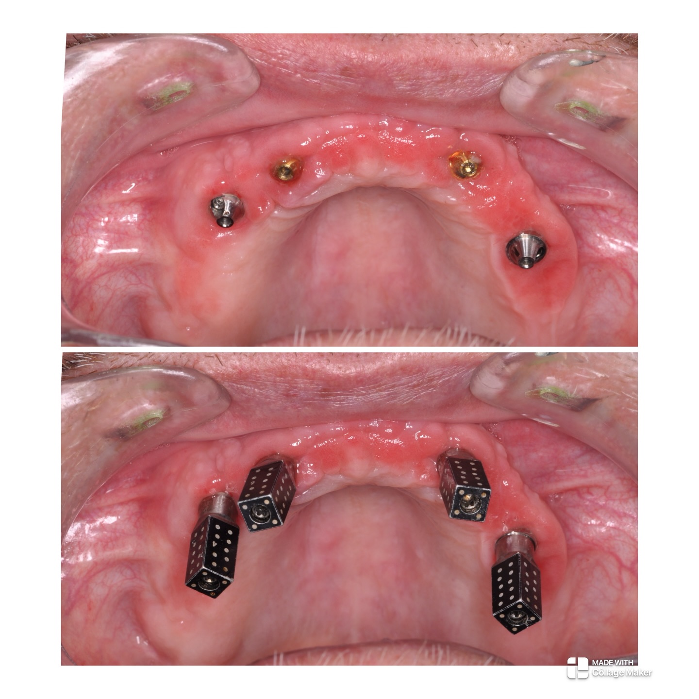 Scanning for full arch final prosthesis with these bad boys #fullarch #fullarchdentalimplants #dentalimplantsprestwich #allon4manchester #fullarchimplantsmanchester