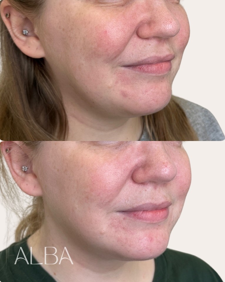 Early progress, the right way
Just one session in, and we’re already seeing a shift in skin quality and support.
With younger patients, this isn’t about adding it’s about maintaining. Collagen banking helps to reinforce what’s naturally there, slowing down early loss and keeping the skin stronger for longer.
You can see a subtle lift through the lower face, a cleaner jawline, and softening where heaviness was starting to sit.
Nothing overdone. Just skin behaving better.
📍 ALBA Skin Clinic, Cirencester
📞 01285 238070
#SculptraCirencester #CollagenBanking #NaturalResults #RadiesseCirencester #Biostimulator