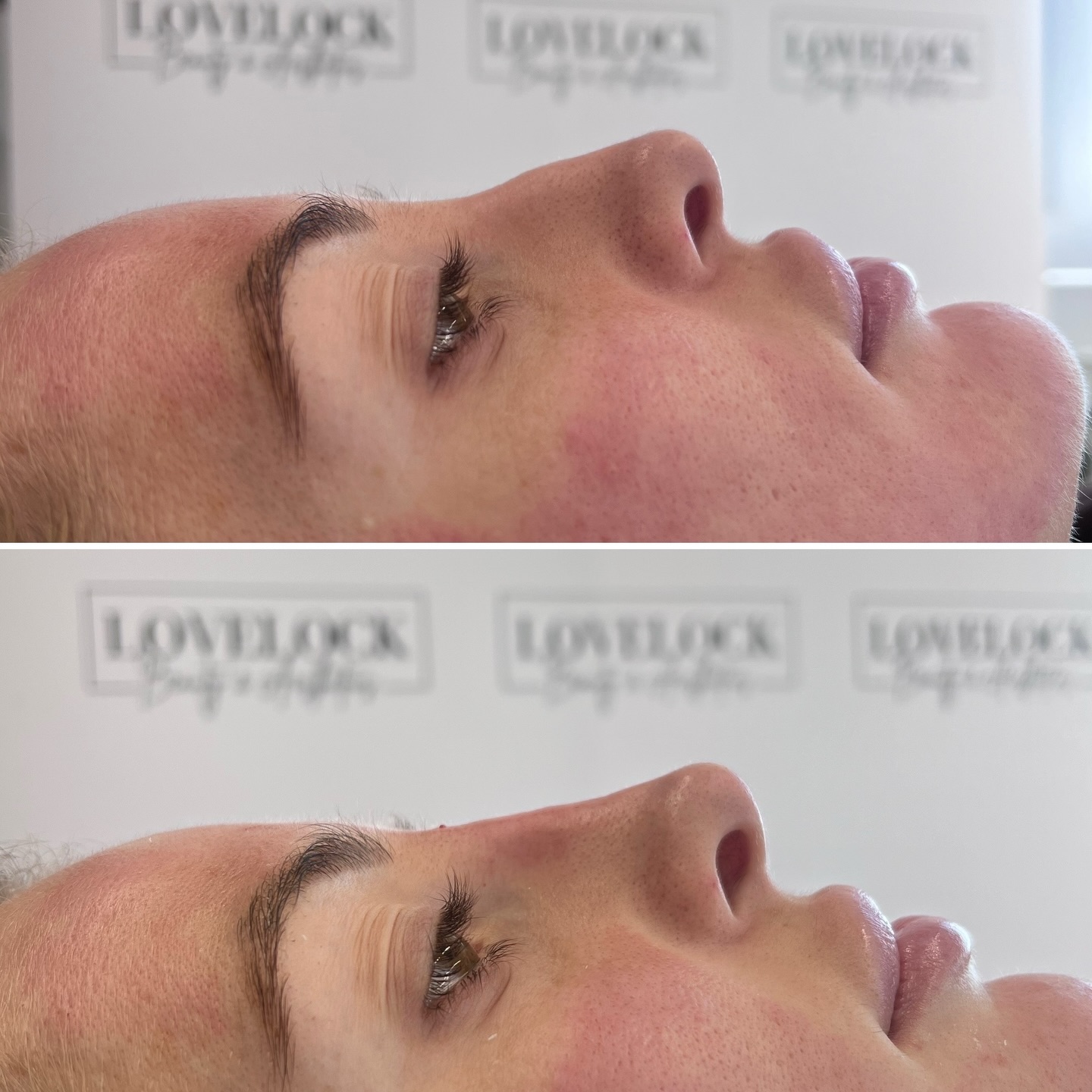 NO NEED FOR PAINFUL SURGERY!
If you’re looking to change your side profile, it can easily be done! Just look at these amazing results on my clients.
⭐️ Award-winning level 7 aesthetic practitioner
📍 Romsey 📍 Warminster
#warminster #westbury #trowbridge #romsey #southamptonuk