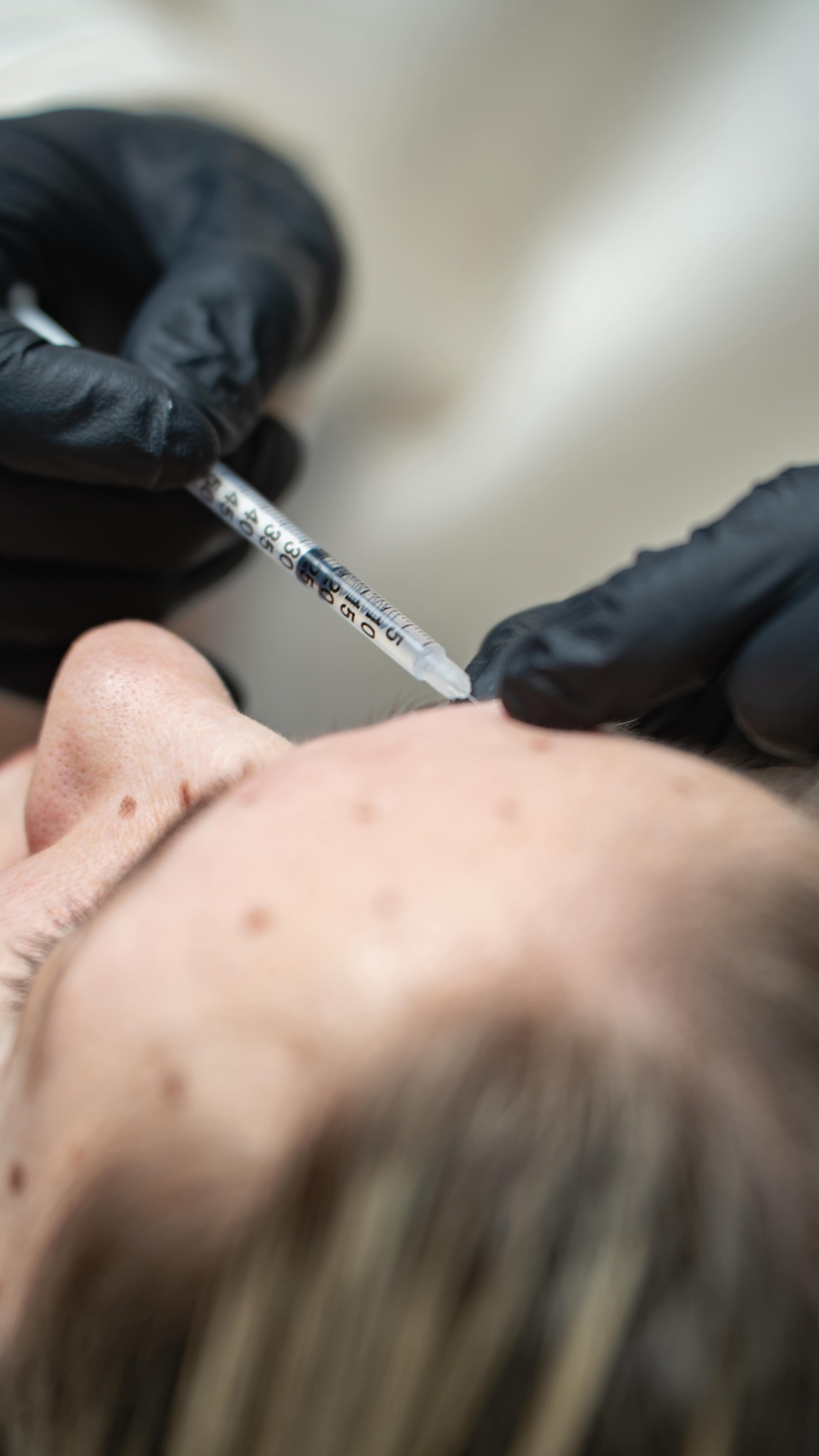 When you don’t want your skin to look like it’s just had a treatment.
btx and hyaluronic acid can complement each other perfectly when it comes to gently harmonizing the face and specifically smoothing out signs of aging.
While btx relaxes expression lines, hyaluronic acid can restore volume, support facial contours, and bring balance back to the face. The key is not to use as much as possible, but to achieve a result that looks soft, fresh, and harmonious.
•
•
Wenn Frische nicht nach Behandlung aussehen soll.
Btx und Hyaluron können sich ideal ergänzen, wenn es darum geht, das Gesicht sanft zu harmonisieren und Zeichen der Hautalterung gezielt auszugleichen.
Während Btx mimische Falten entspannt, kann Hyaluron Volumen ausgleichen, Konturen unterstützen und dem Gesicht wieder mehr Balance geben.
Entscheidend ist nicht möglichst viel, sondern ein Ergebnis, das weich, frisch und stimmig wirkt.
•
#dermedesthetic #btx #facial