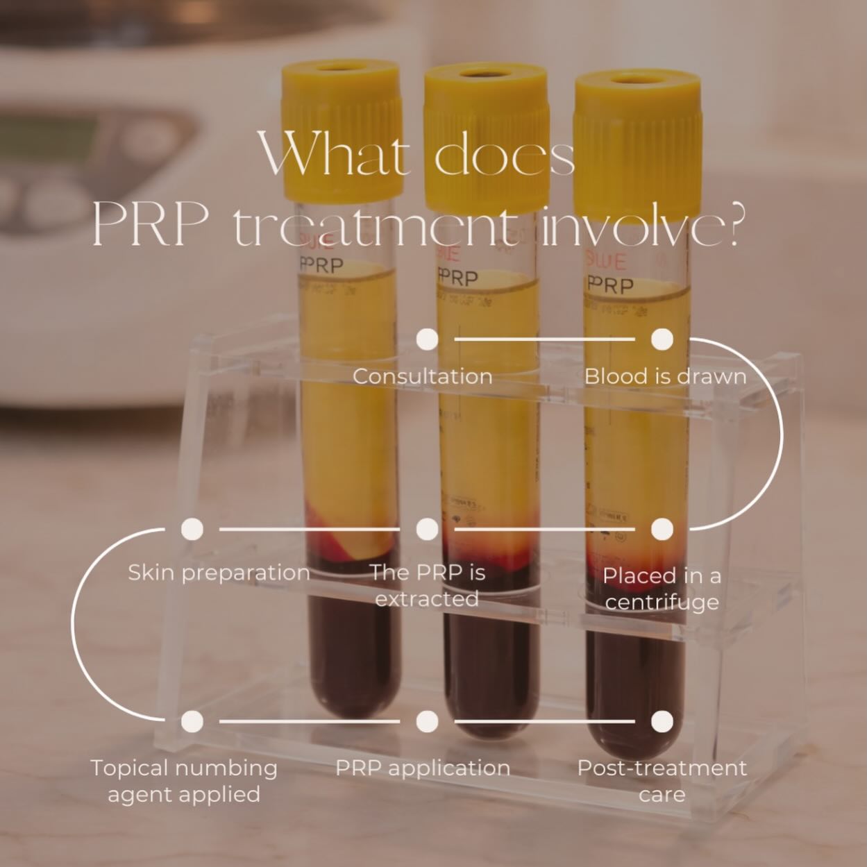 PRP stands for Platelet-Rich Plasma therapy. It’s a treatment that uses your own blood to help repair and rejuvenate your skin.
🧪 What it actually is
• A small amount of your blood is taken (like a blood test)
• It’s spun in a machine to separate out the platelets (these are rich in growth factors)
• That concentrated plasma is then applied or injected into your skin
Because it comes from your own body, the risk of reactions is very low. This treatment can be injected into the skin or used with microneedling. We have a special offer for April £150 for prp with microneedling usually £250. #aestheticsbyam #oxfordclinic #oxfordsalon