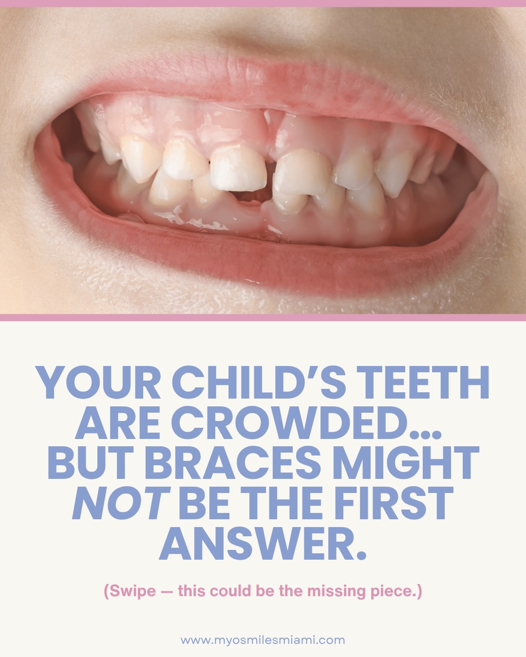 If you’re a parent looking at your child’s crowded teeth and wondering, “Do we really just wait for braces?”…you’re not alone.
Crowding can be a sign of more than tooth alignment. In many cases, it’s connected to mouth breathing, open-mouth posture, low tongue posture, snoring, grinding, or oral habits that affect how the jaws grow.
At Myosmiles, Dr. Ingrid focuses on early myofunctional orthodontics and myofunctional therapy to support nasal breathing, healthy tongue function, and proper oral muscle patterns…the foundation that can influence spacing for adult teeth.
📩 Want a professional opinion for your child (ages 3–12)?
DM “CONSULT” and we’ll set up a consultation and walk you through next steps.
✅ Save this post so you can reference it later.
.
.
.
early orthodontics | myofunctional orthodontics | myofunctional therapy | nasal breathing | mouth | breathing kids | tongue posture | tongue tie evaluation | pediatric dentist | kids dental crowding | airway dentistry | open mouth posture | teeth grinding children | snoring in children | habit correction | jaw growth guidance
#myobrace #earlyorthodontics #pediatricdentist #myotherapy
